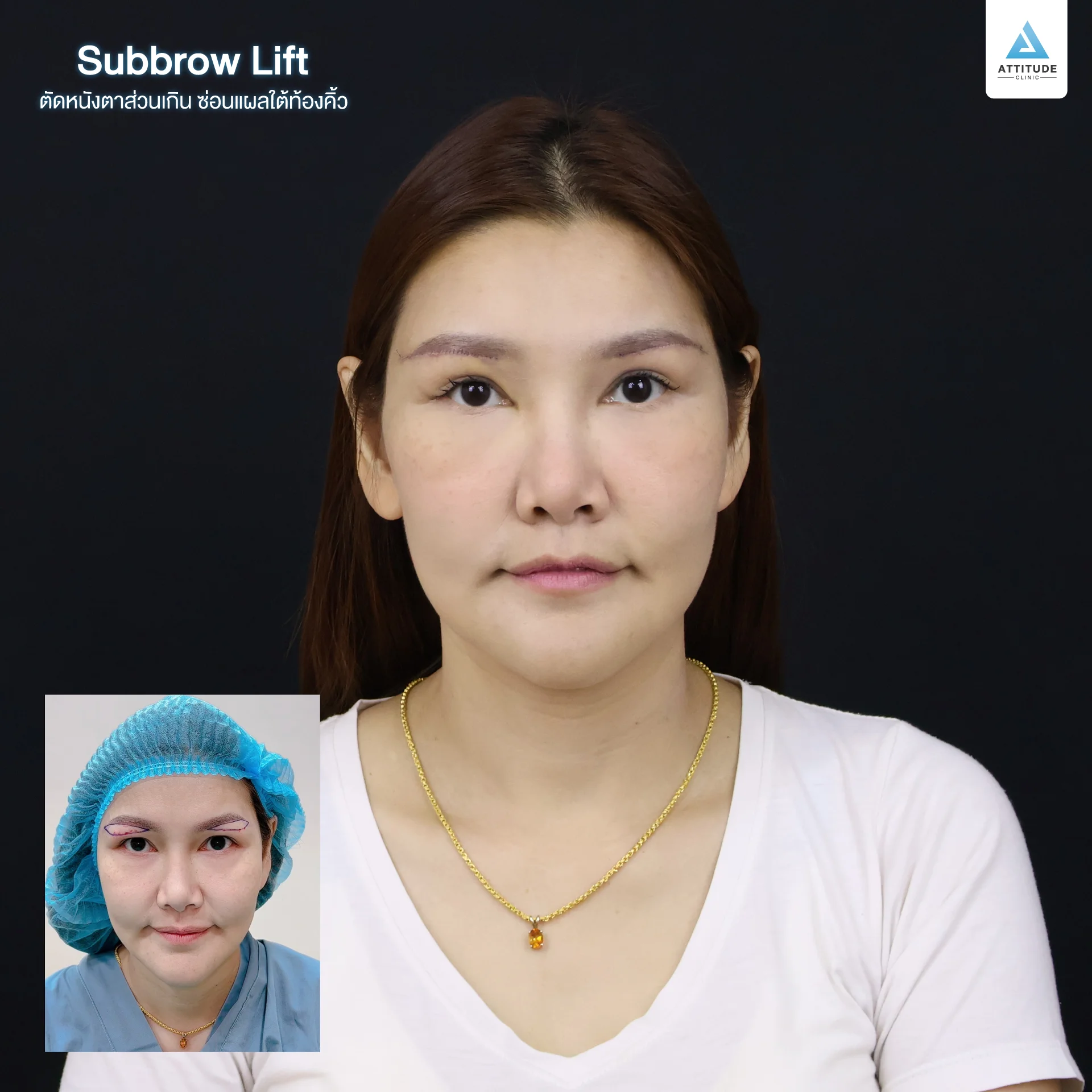 Sub Brow Lift
