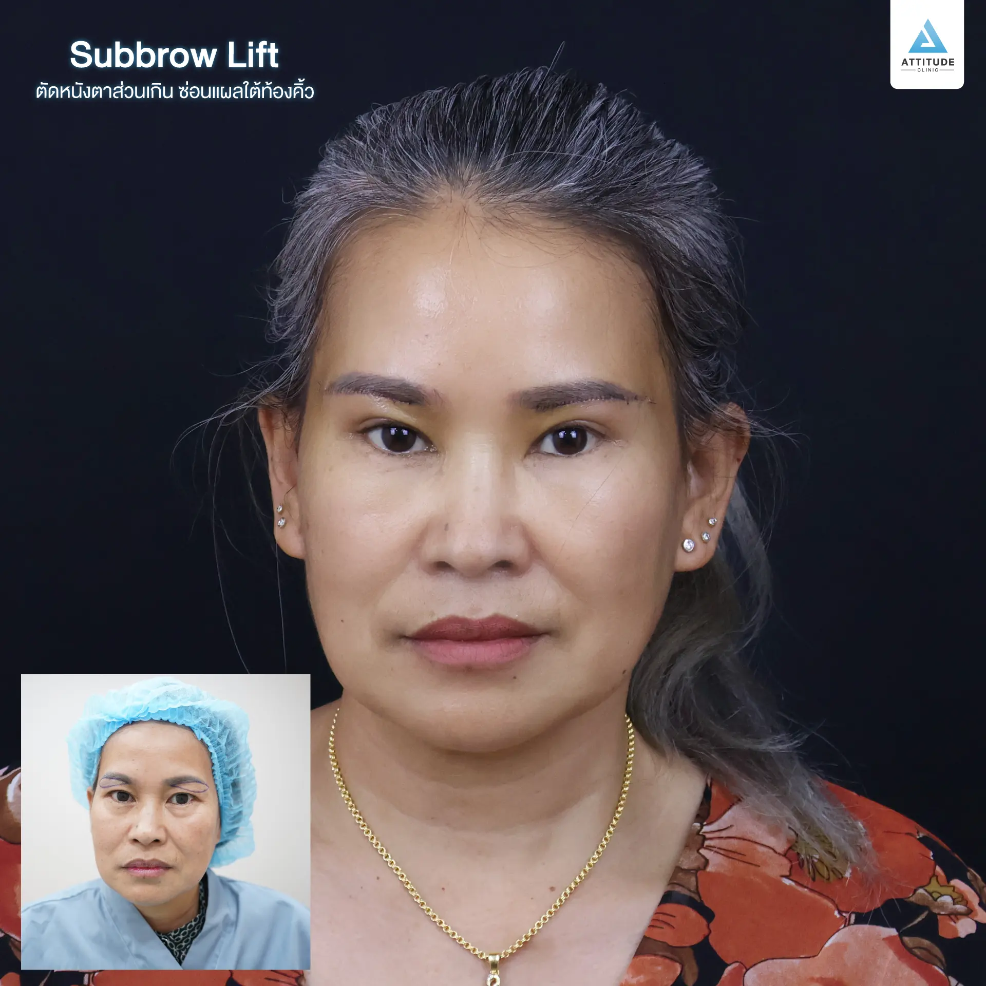 Sub Brow Lift