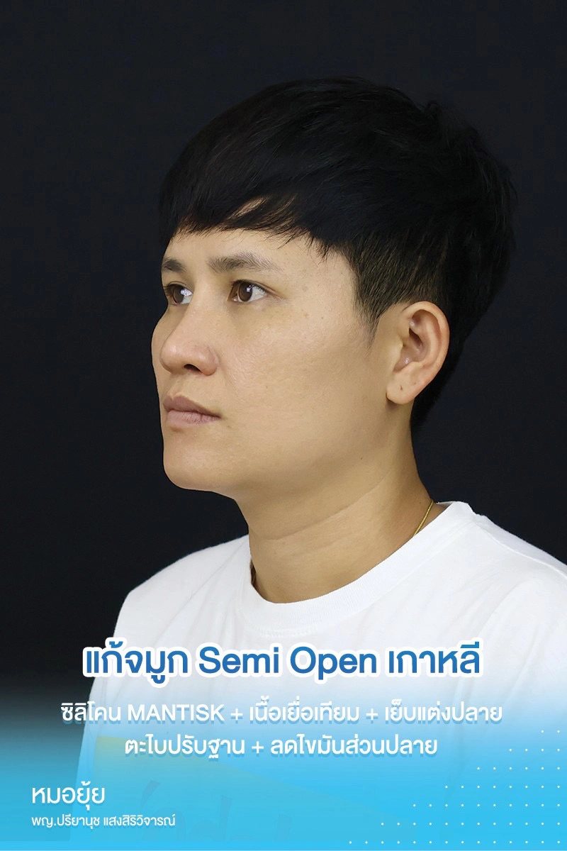 แก้จมูก