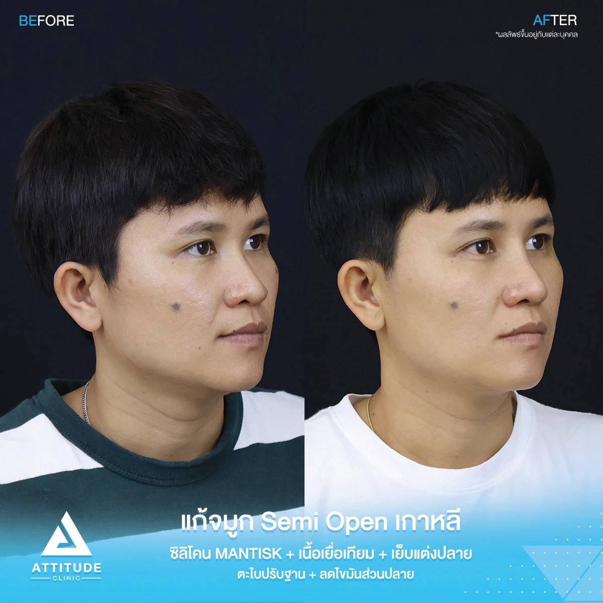 แก้จมูก 