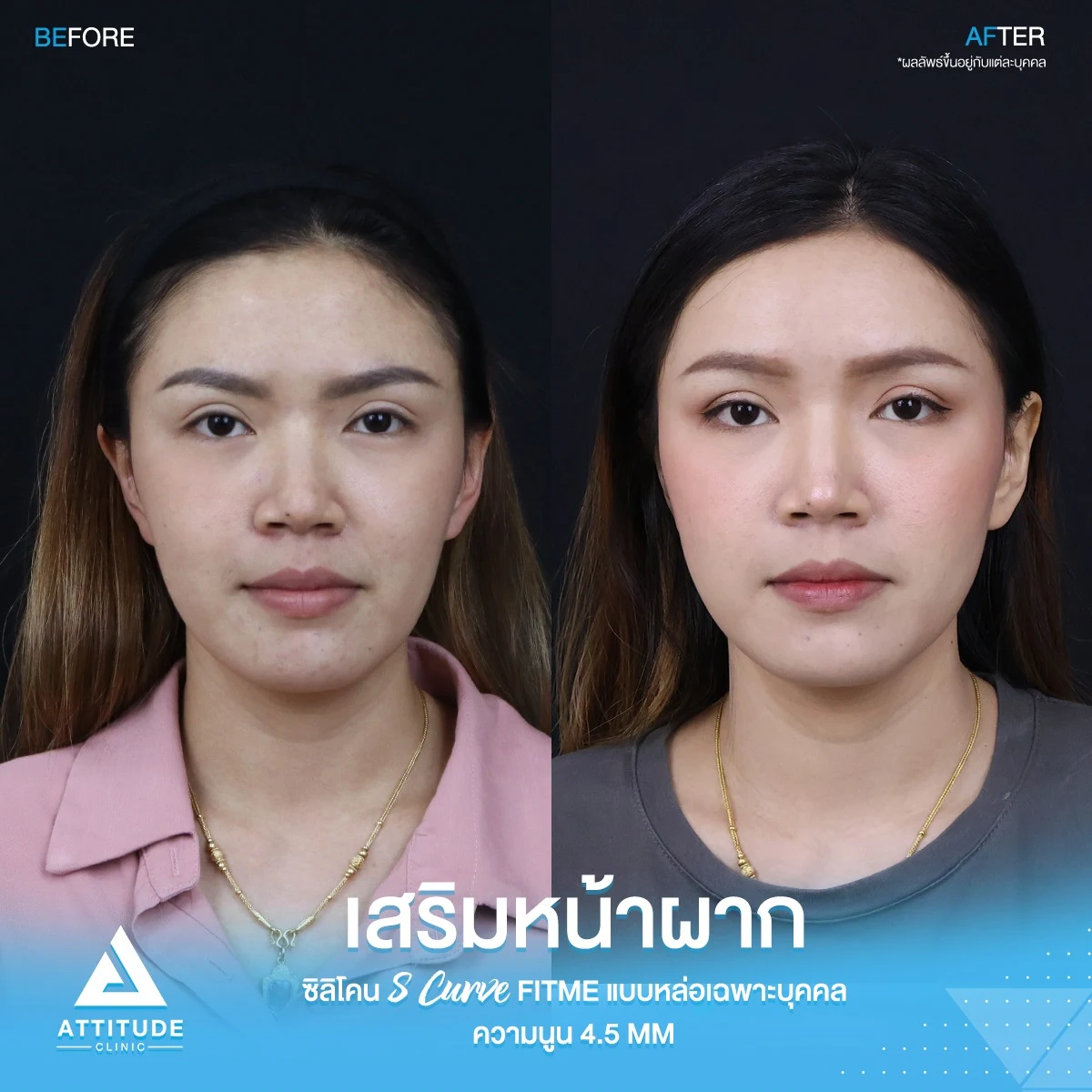 เสริมหน้าผาก