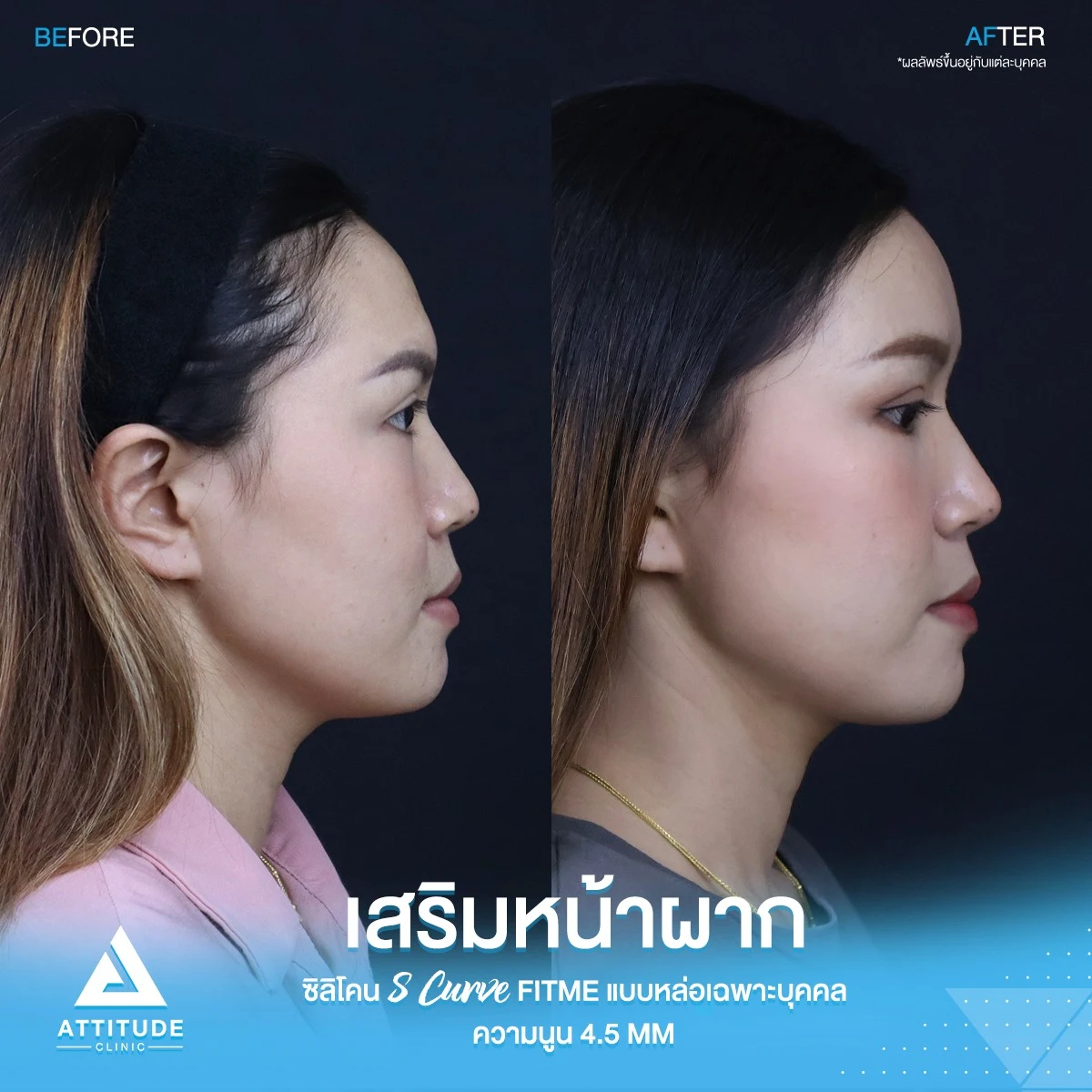 เสริมหน้าผาก