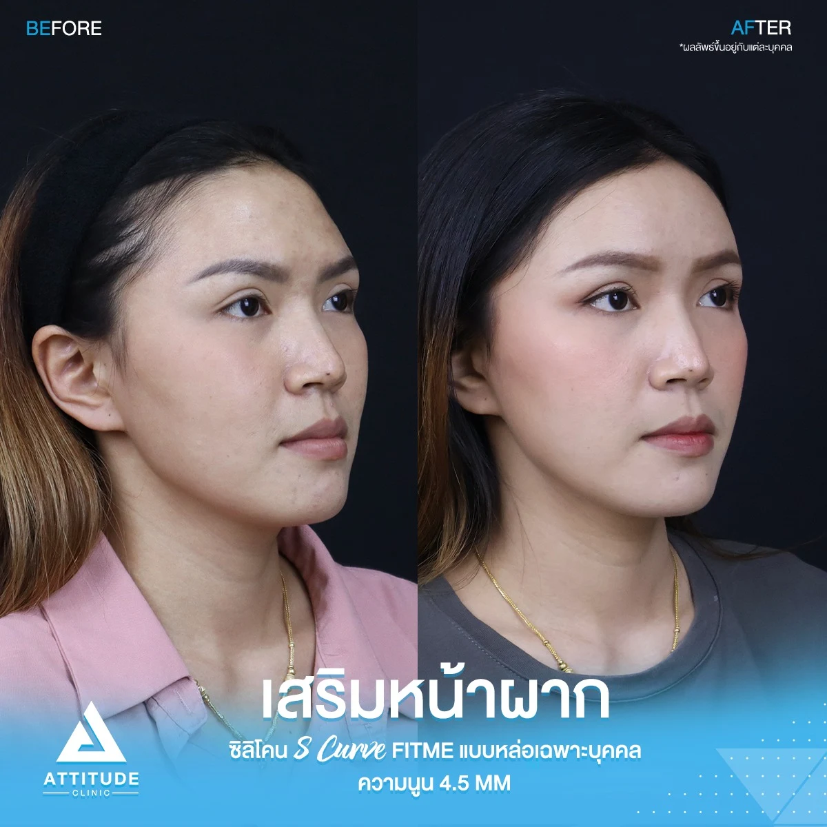 เสริมหน้าผาก