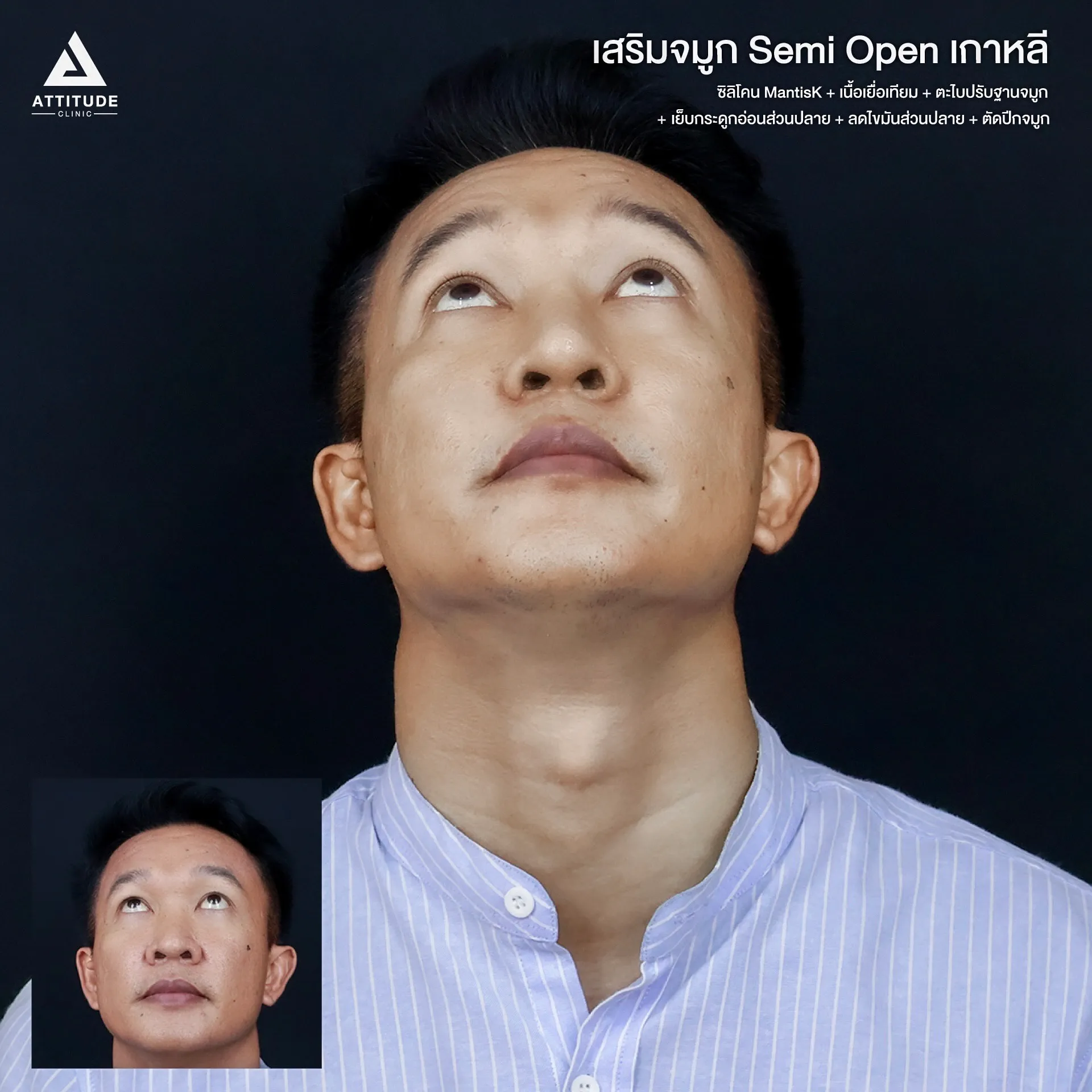 เสริมจมูก