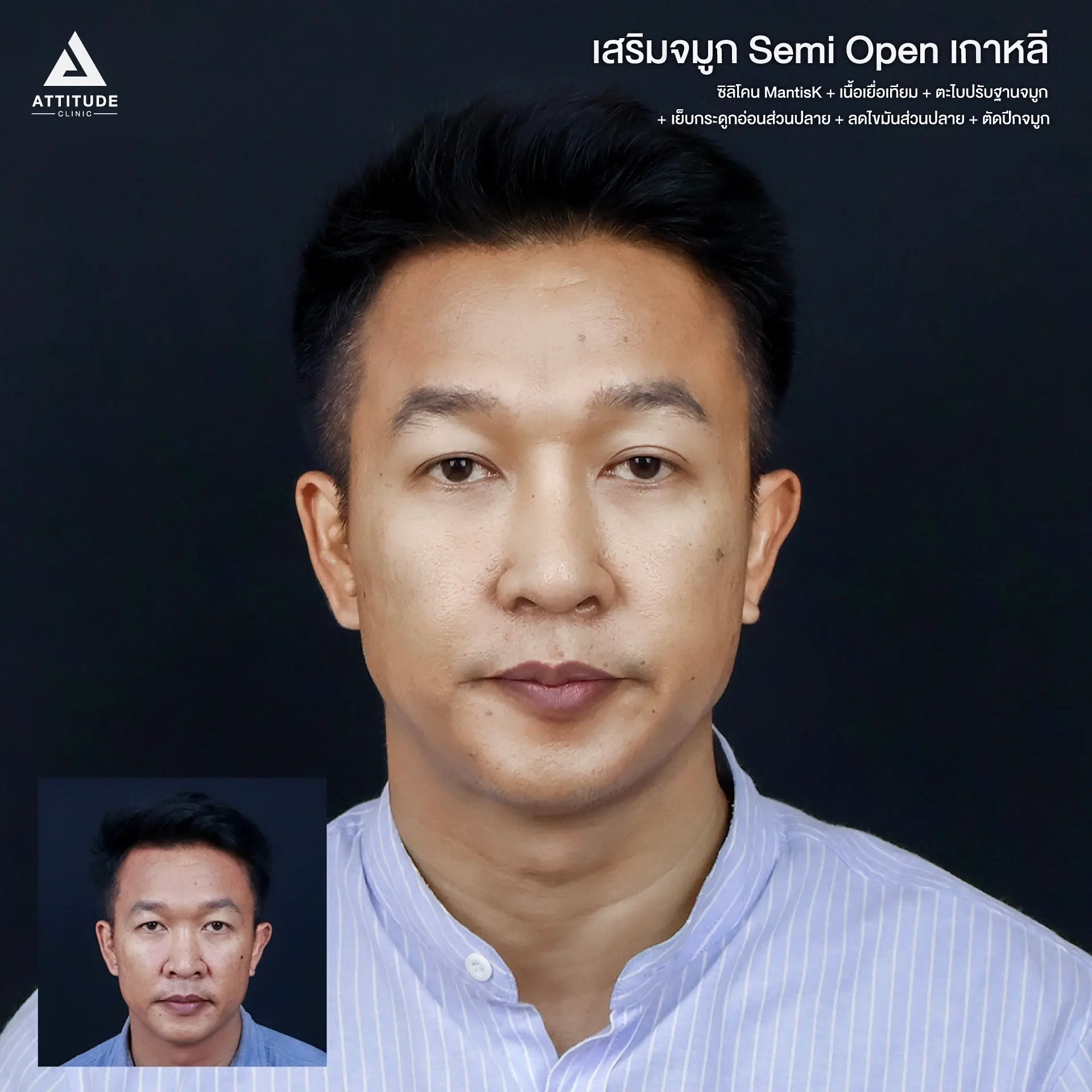 เสริมจมูก