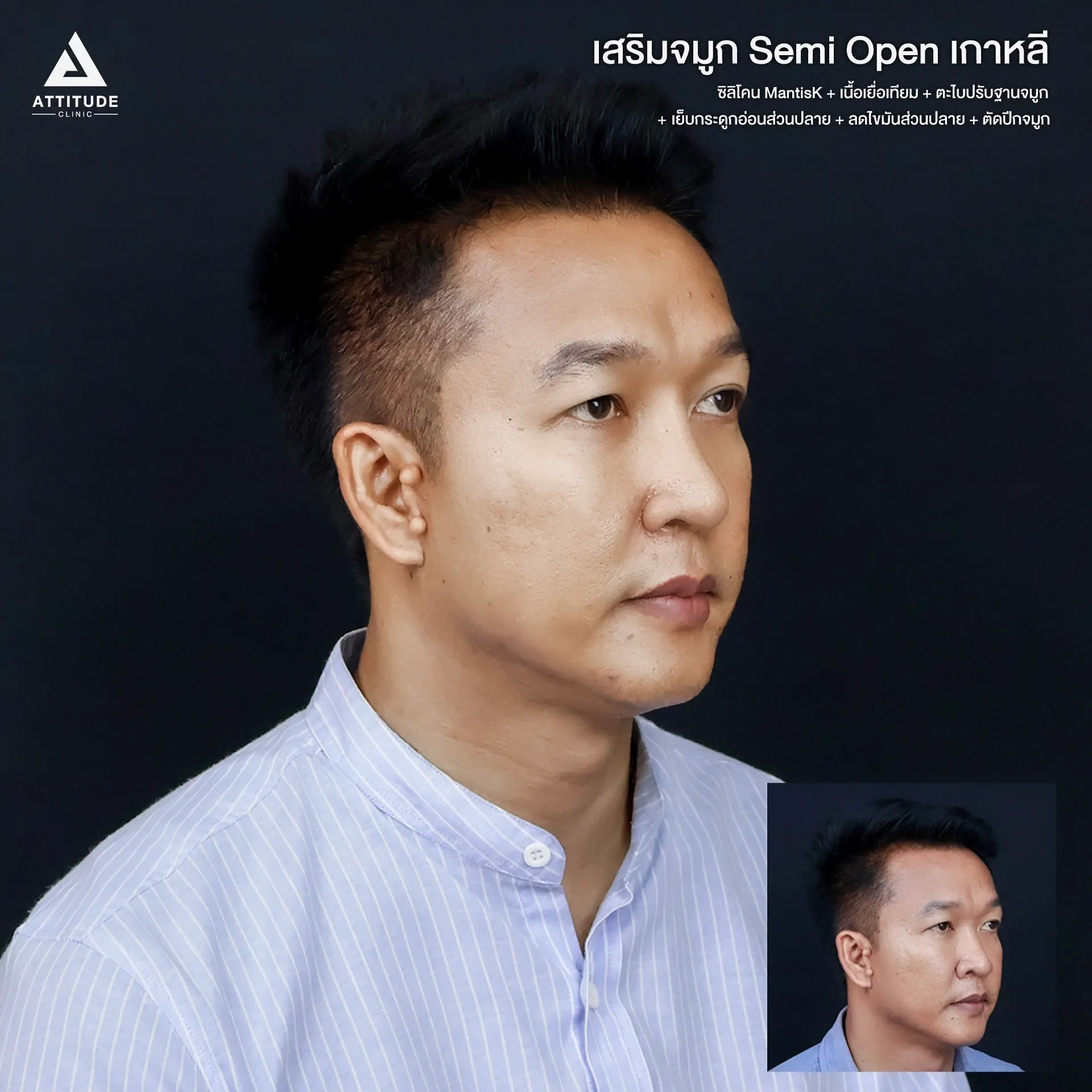 เสริมจมูก