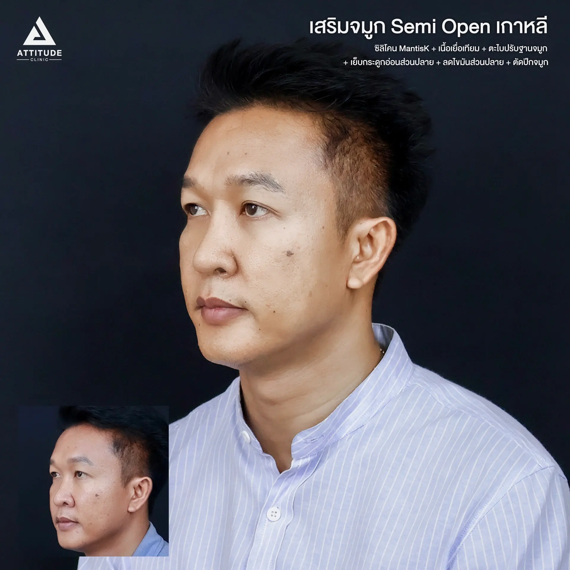 เสริมจมูก