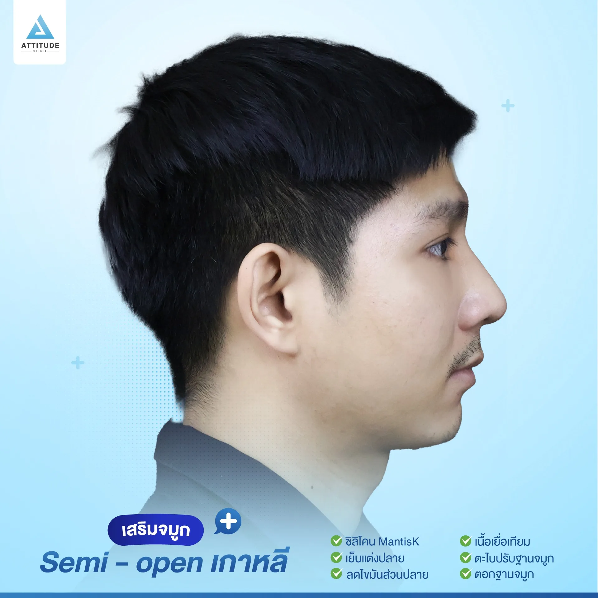 เสริมจมูก