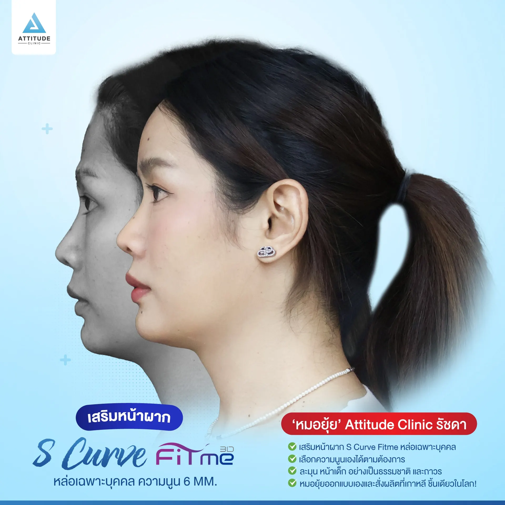 เสริมหน้าผาก