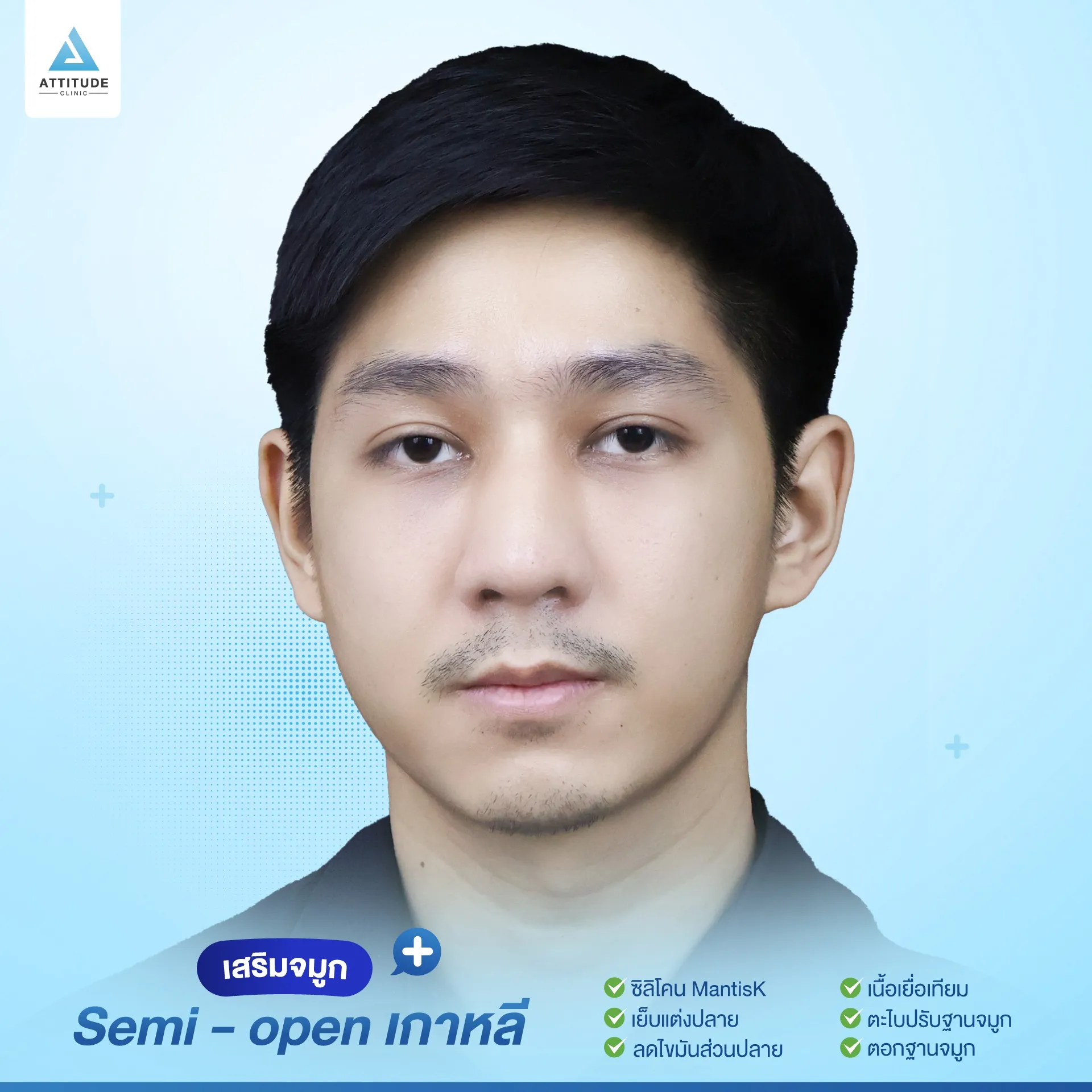 เสริมจมูก