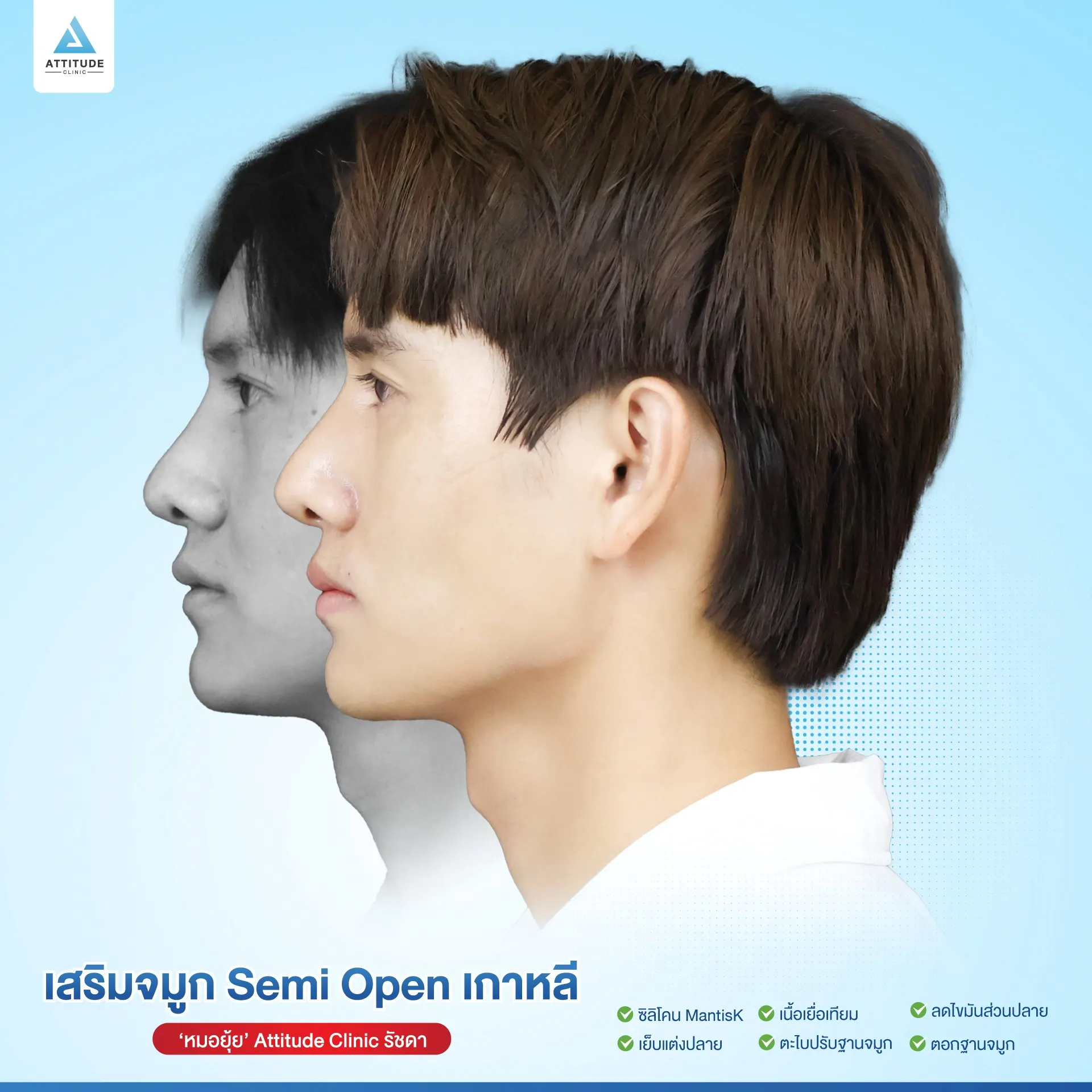 เสริมจมูก