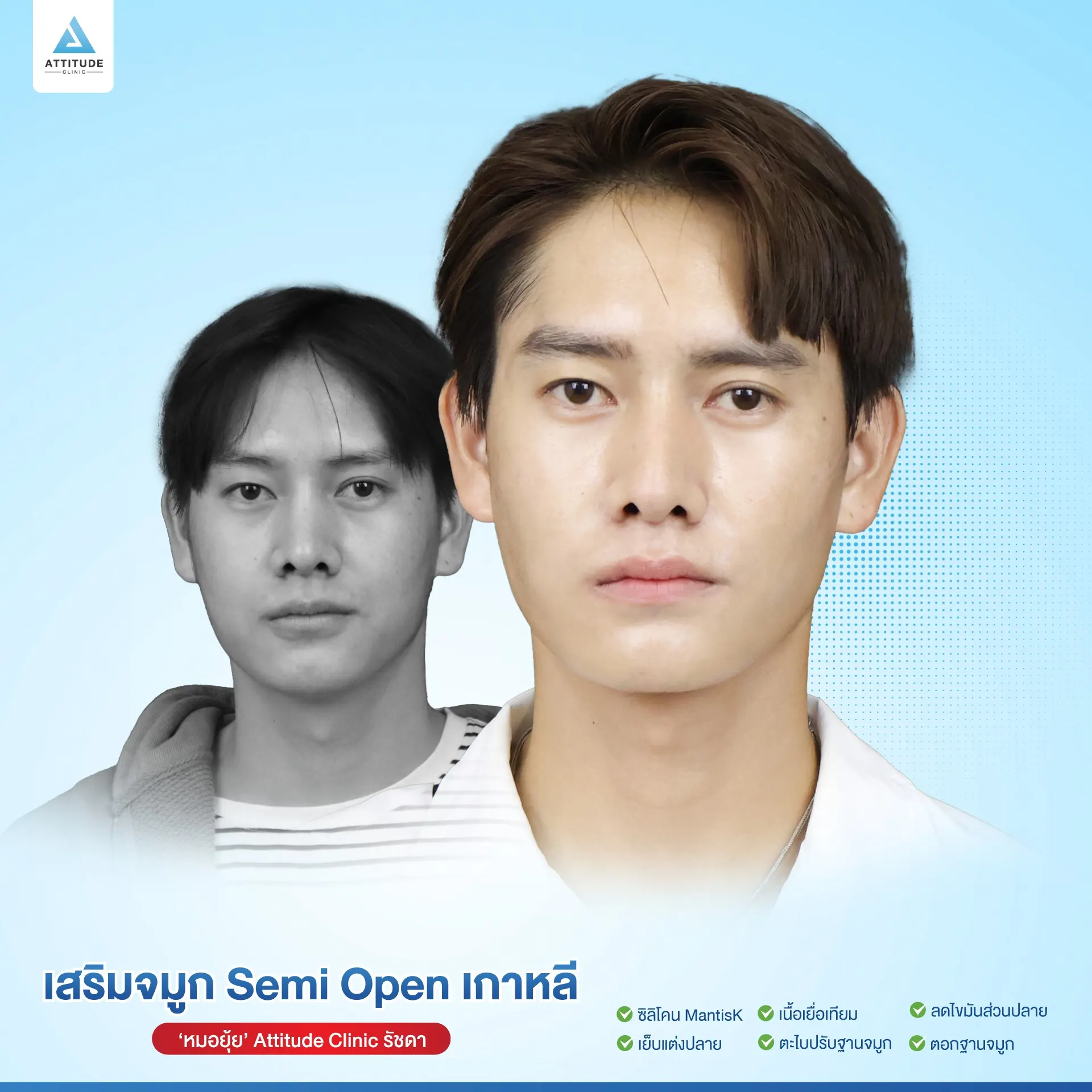 เสริมจมูก
