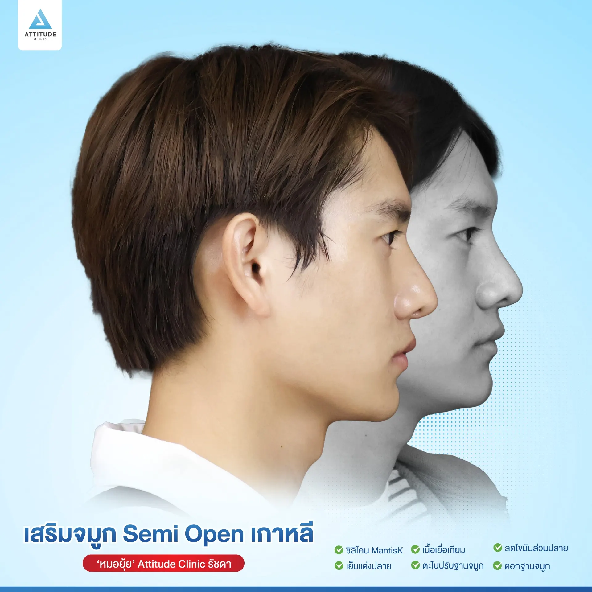 เสริมจมูก