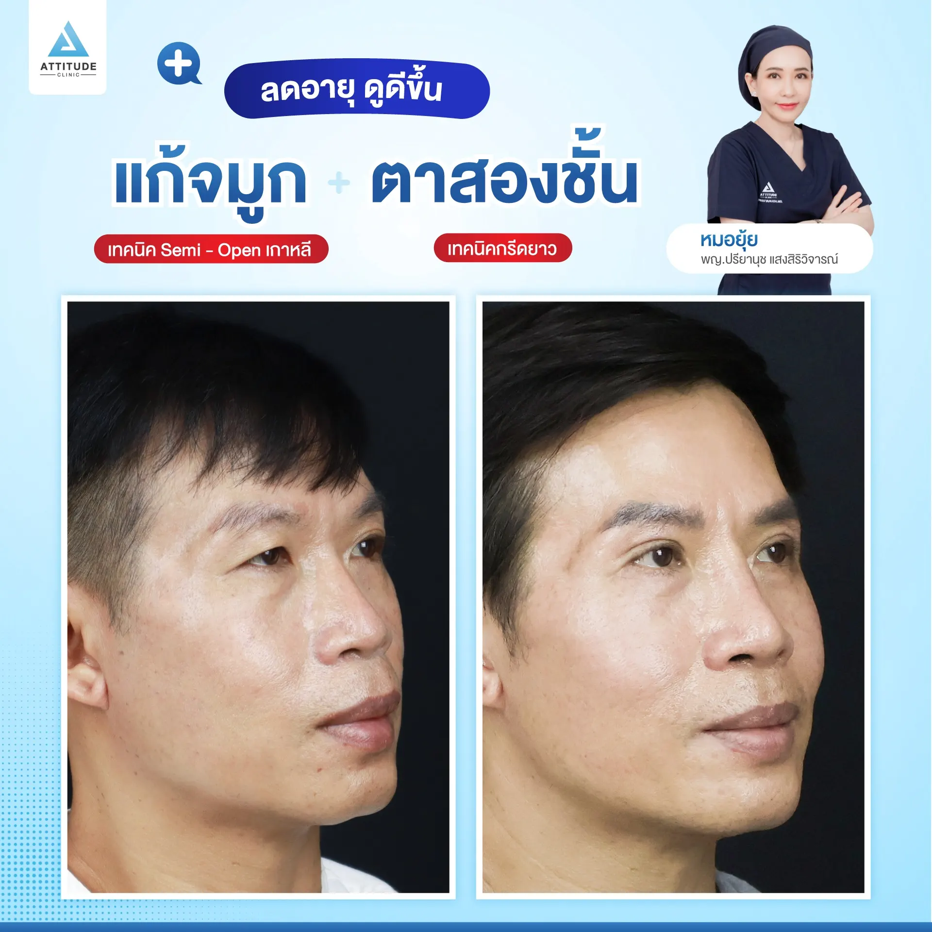 ทำตาสองช้้น เสริมจมูก