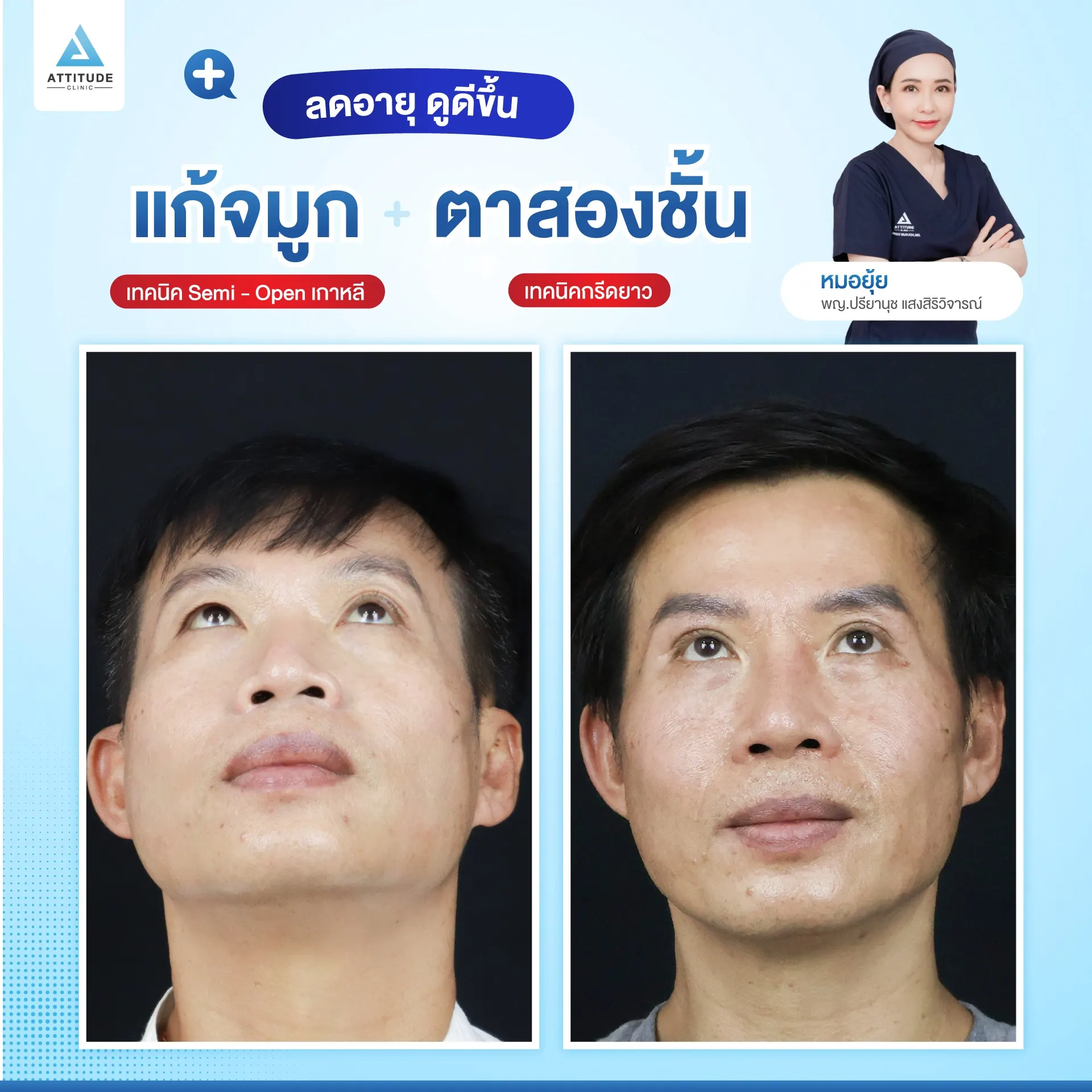 ทำตาสองช้้น เสริมจมูก