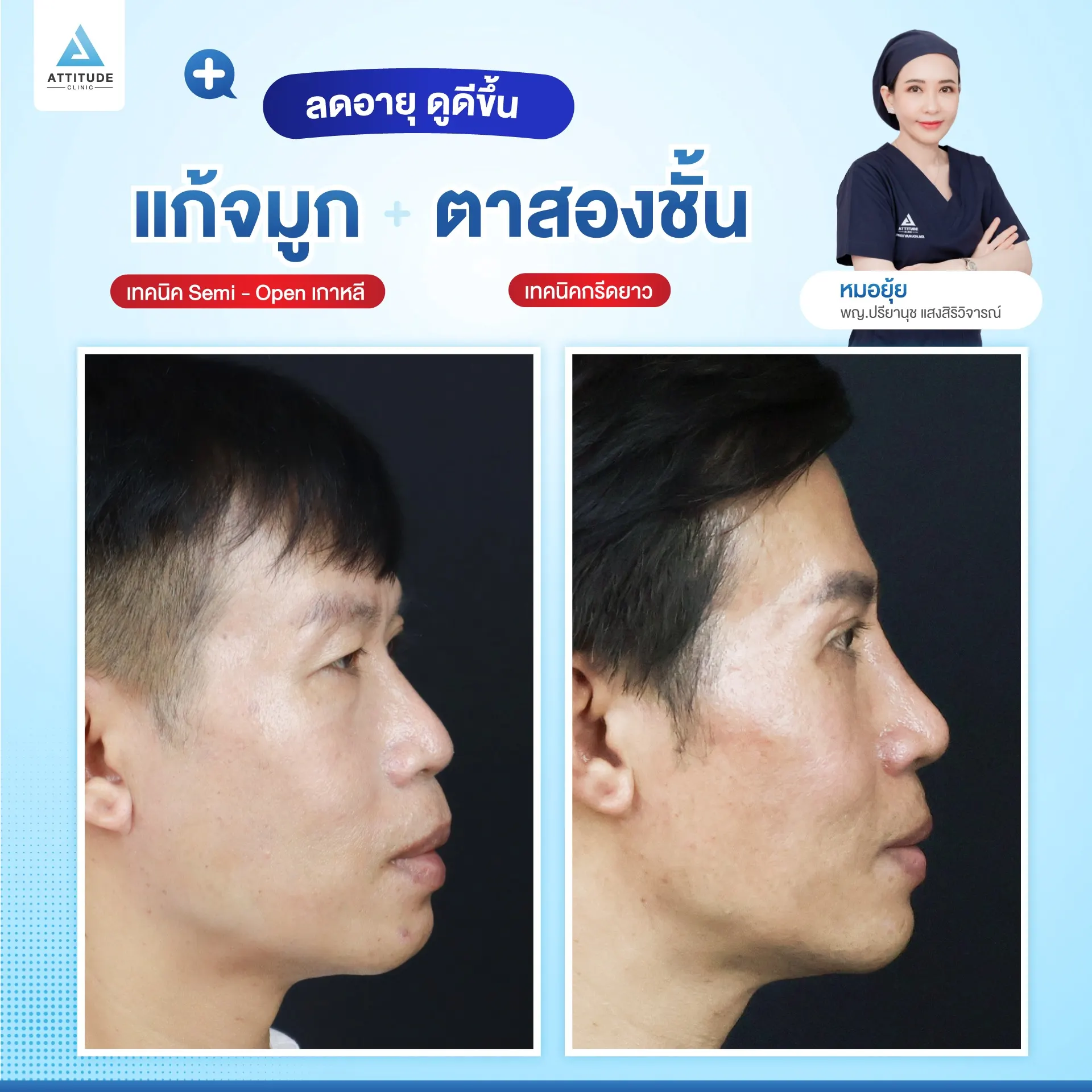 ทำตาสองช้้น เสริมจมูก