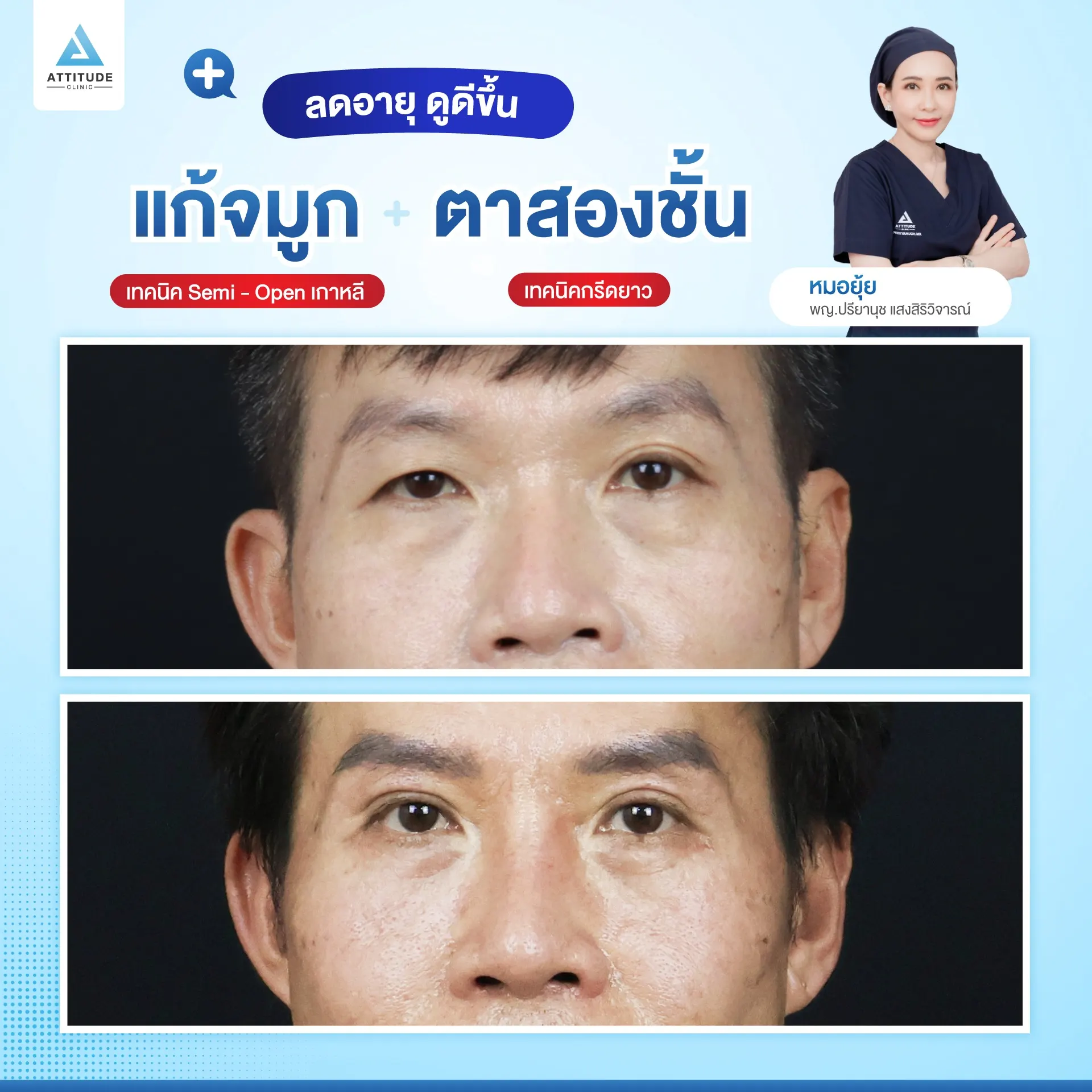 ทำตาสองช้้น เสริมจมูก