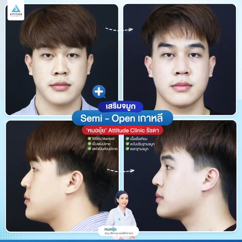 เสริมจมูก