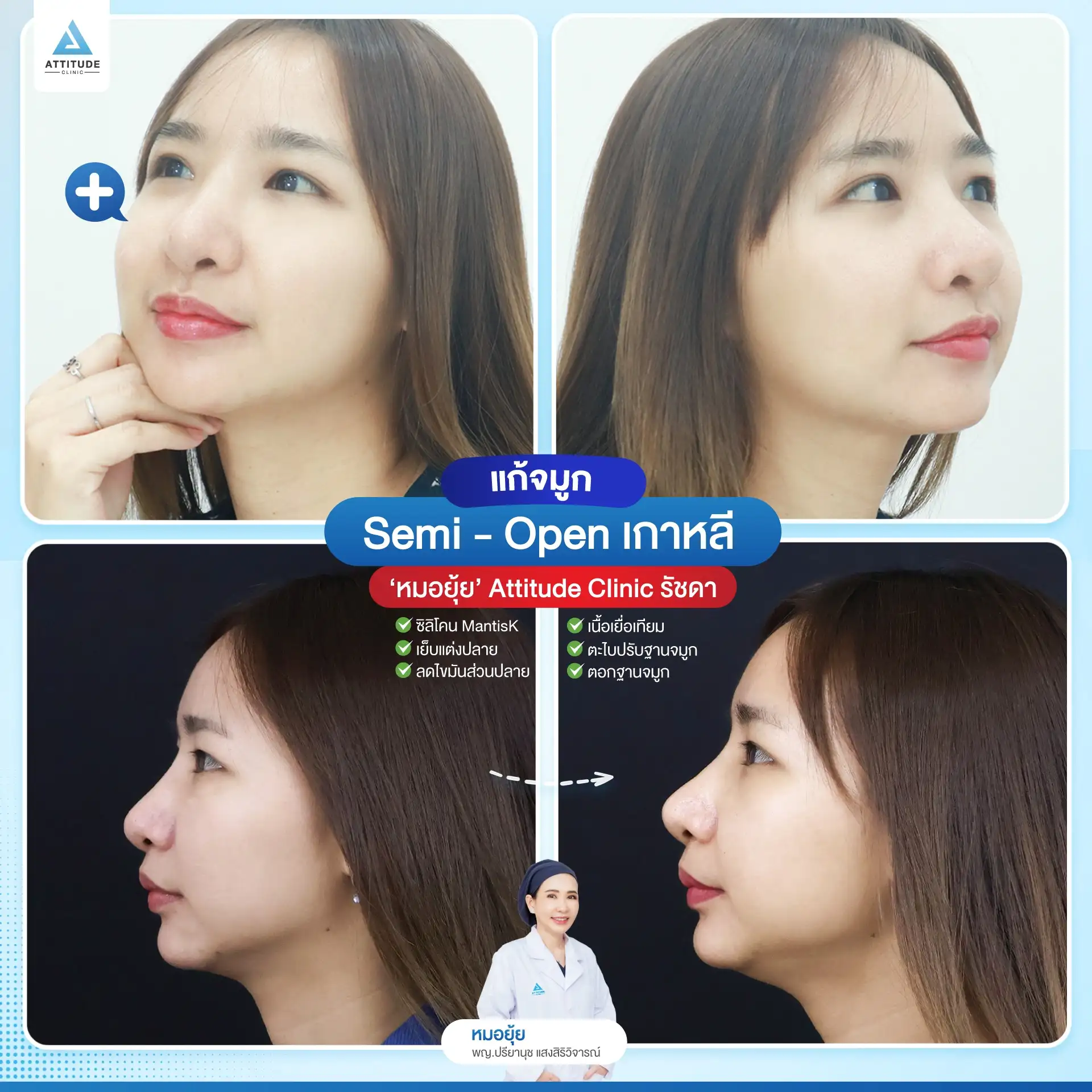 แก้จมูกทรงธรรมชาติ เสริมจมูก