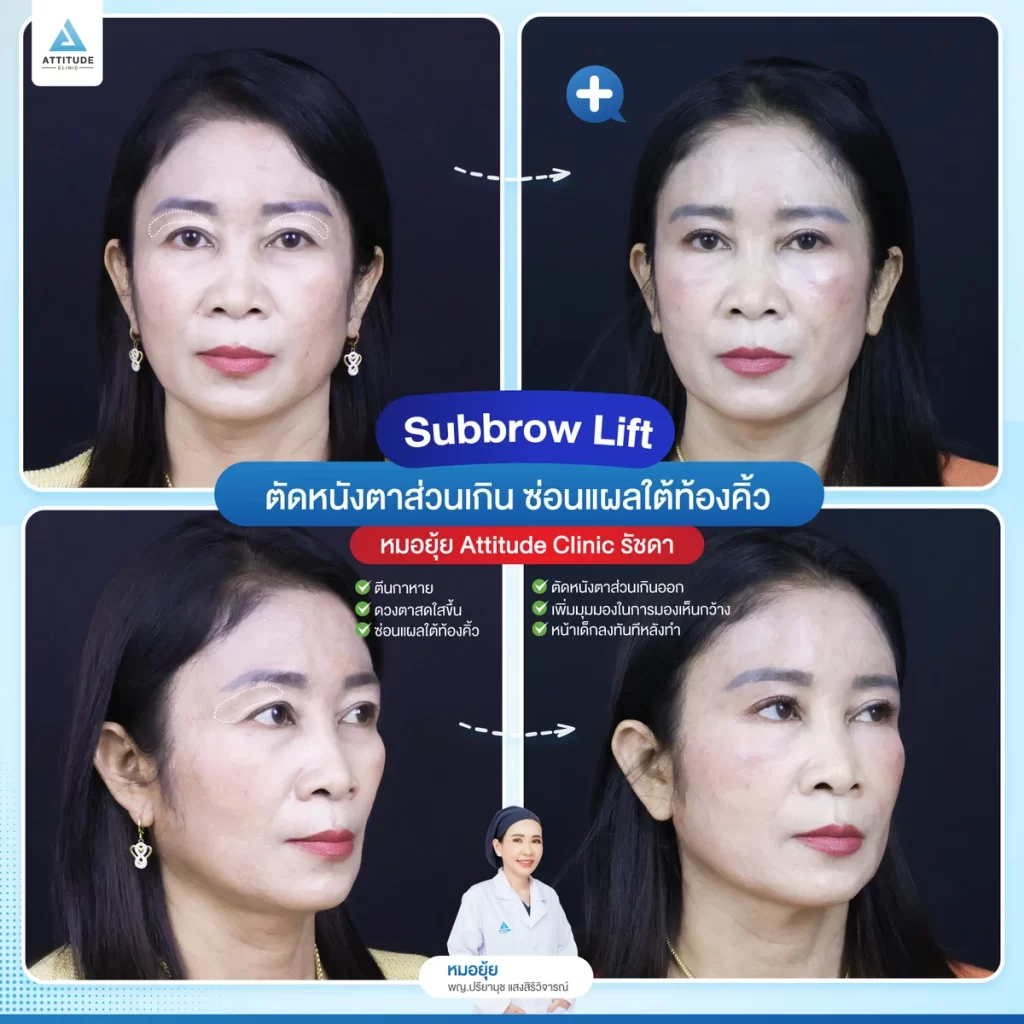 Sub Brow Lift