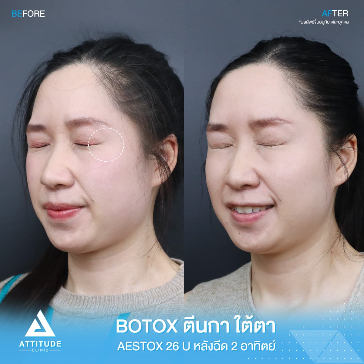 โปรโมชั่นจับคู่ลดริ้วรอยใต้ตา+หน้าผาก เพียง 1,580 บาท คุ้มเกินต้าน! ด้วย Aestox เกาหลีพรีเมียม สูตรลับหน้าเด็กลงใครก็ทักที่ Attitude Clinic