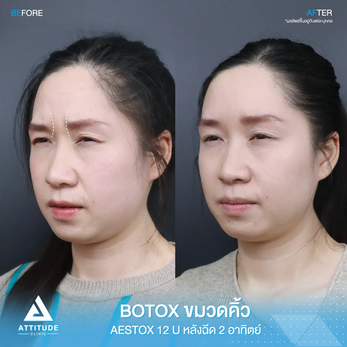 โปรโมชั่นจับคู่ลดริ้วรอยใต้ตา+หน้าผาก เพียง 1,580 บาท คุ้มเกินต้าน! ด้วย Aestox เกาหลีพรีเมียม สูตรลับหน้าเด็กลงใครก็ทักที่ Attitude Clinic