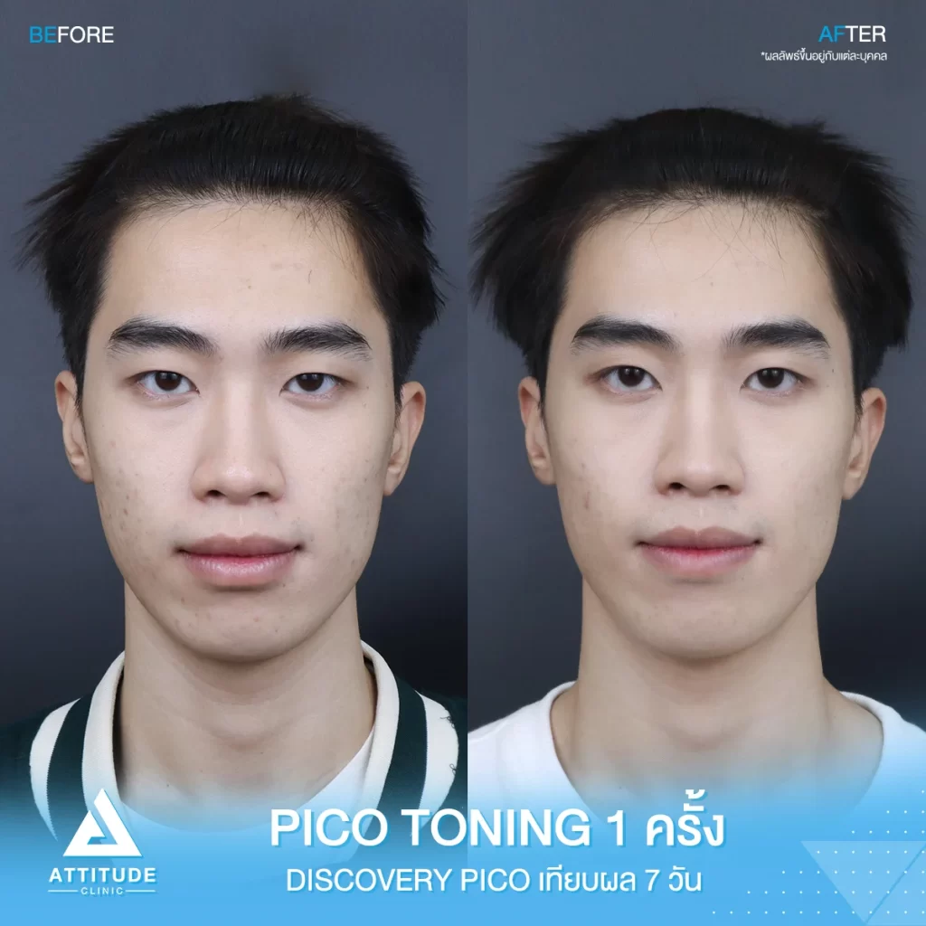 รีวิวรักษารอยสิว Discovery Pico โหมด Toning จำนวน 1 ครั้ง ของน้องไม้เอก ที่มีปัญหารอยสิว รอยจุดด่างดำ ผิวไม่สม่ำเสมอ หลังทำครบ 7 วัน ผิวใส รอยจางชัดเจน ปังสุดๆ