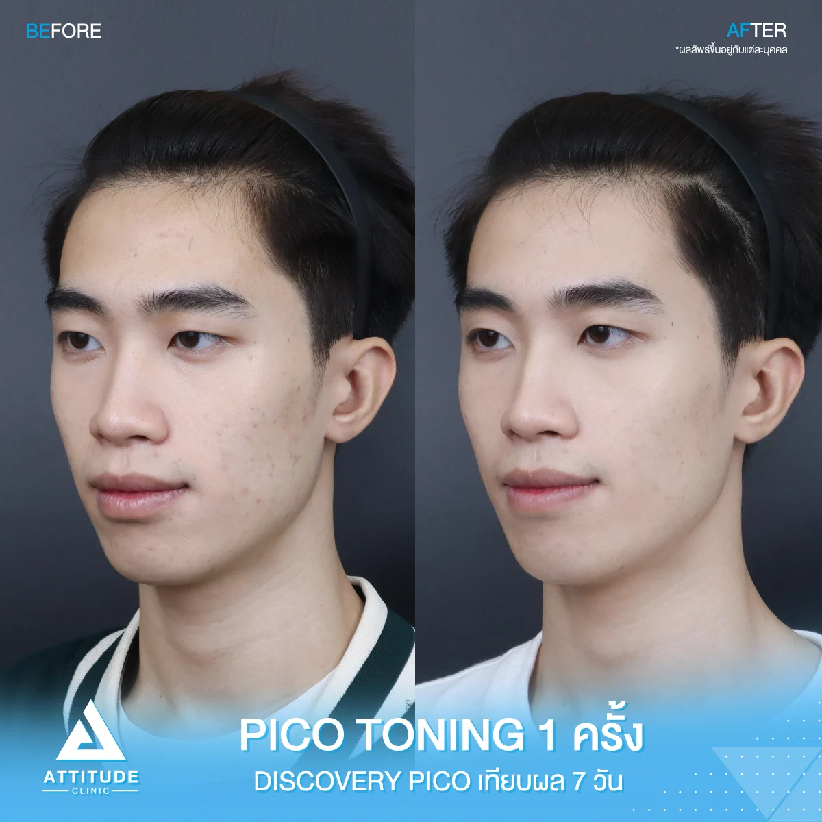 รีวิวรักษารอยสิว Discovery Pico โหมด Toning จำนวน 1 ครั้ง ของน้องไม้เอก ที่มีปัญหารอยสิว รอยจุดด่างดำ ผิวไม่สม่ำเสมอ หลังทำครบ 7 วัน ผิวใส รอยจางชัดเจน ปังสุดๆ 