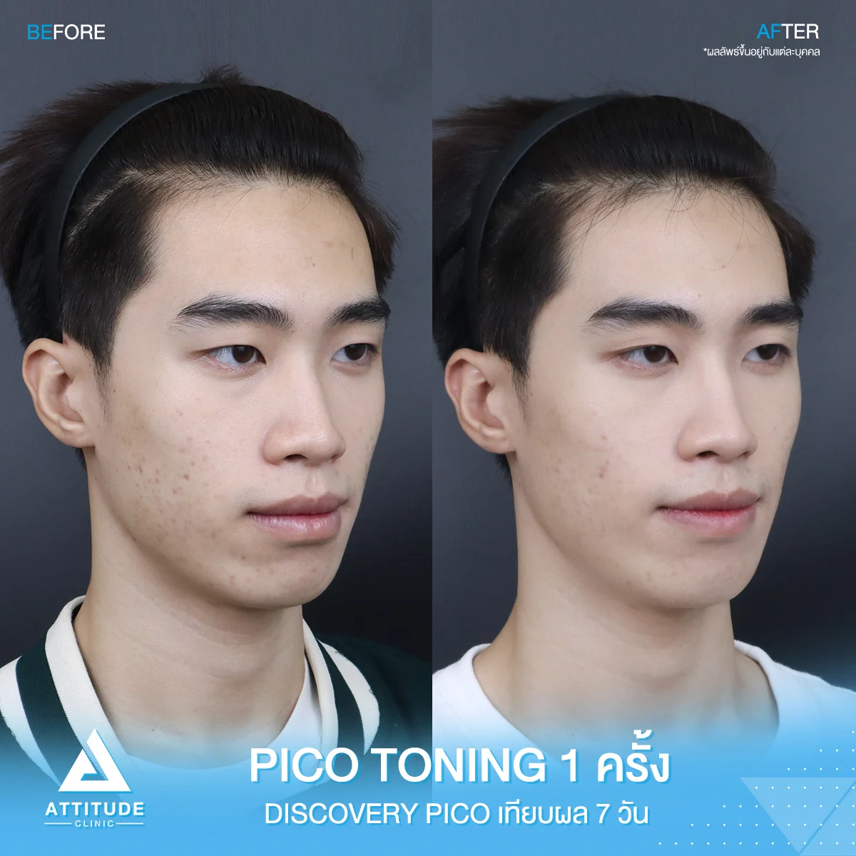 รีวิวรักษารอยสิว Discovery Pico โหมด Toning จำนวน 1 ครั้ง ของน้องไม้เอก ที่มีปัญหารอยสิว รอยจุดด่างดำ ผิวไม่สม่ำเสมอ หลังทำครบ 7 วัน ผิวใส รอยจางชัดเจน ปังสุดๆ 