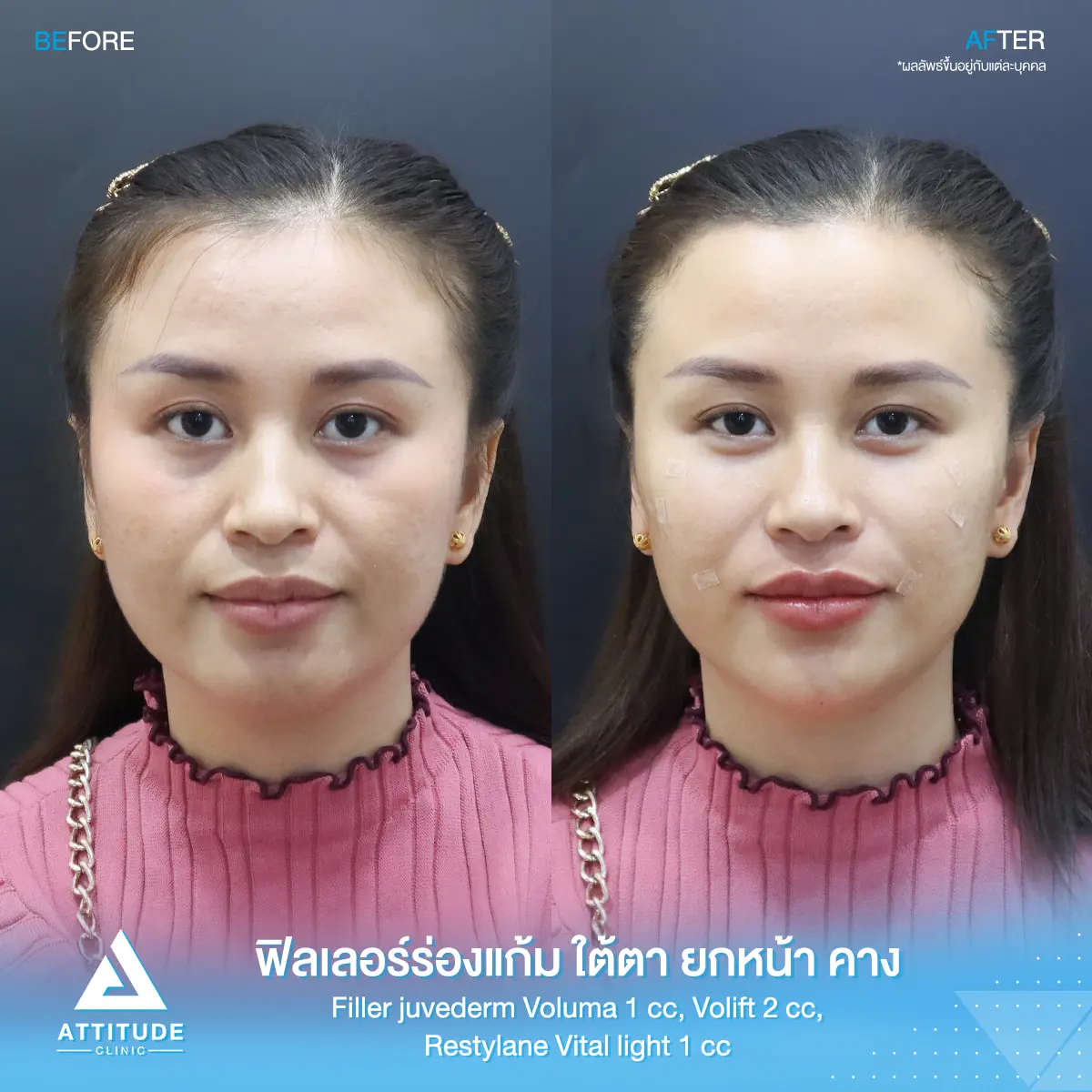 รีวิวฉีดฟิลเลอร์ร่องแก้ม ใต้ตา ยกหน้า คาง Juvederm Voluma 1 cc, Juvederm Volift 2 cc และ Restylane Vital Light 1 cc รวม 4 cc ของคุณศรีมล เติมเต็มปรับรูปหน้า แก้หน้าโทรมให้สดใส ย้อนวัยที่ Attitude Clinic