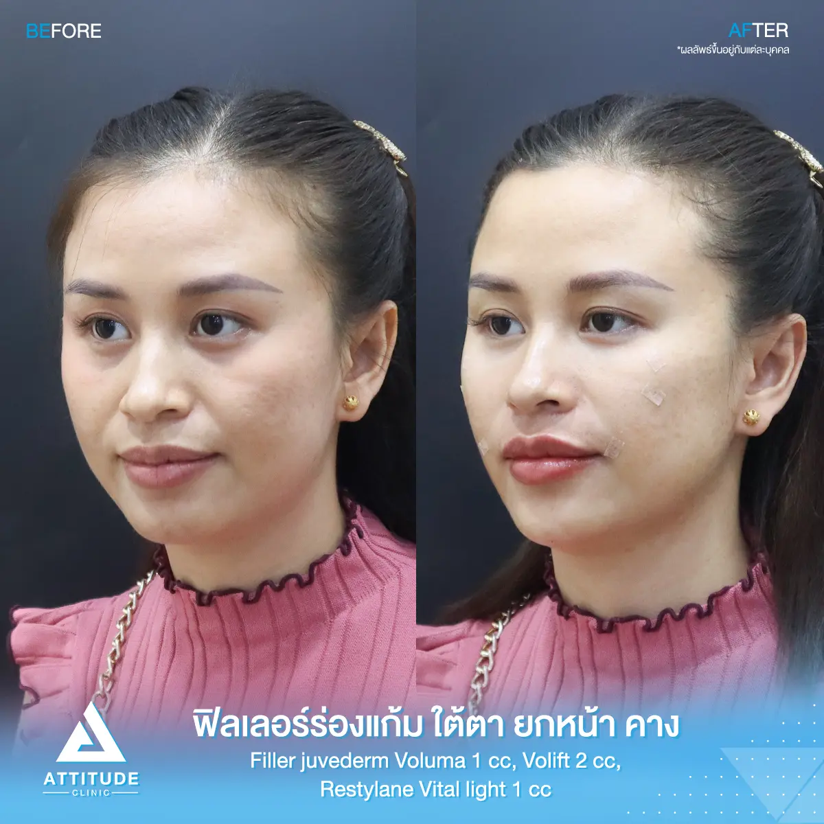 รีวิวฉีดฟิลเลอร์ร่องแก้ม ใต้ตา ยกหน้า คาง Juvederm Voluma 1 cc, Juvederm Volift 2 cc และ Restylane Vital Light 1 cc รวม 4 cc ของคุณศรีมล เติมเต็มปรับรูปหน้า แก้หน้าโทรมให้สดใส ย้อนวัยที่ Attitude Clinic