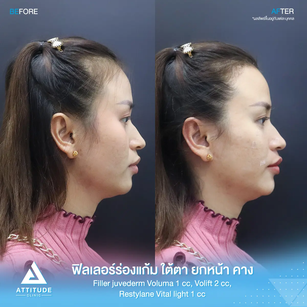 รีวิวฉีดฟิลเลอร์ร่องแก้ม ใต้ตา ยกหน้า คาง Juvederm Voluma 1 cc, Juvederm Volift 2 cc และ Restylane Vital Light 1 cc รวม 4 cc ของคุณศรีมล เติมเต็มปรับรูปหน้า แก้หน้าโทรมให้สดใส ย้อนวัยที่ Attitude Clinic