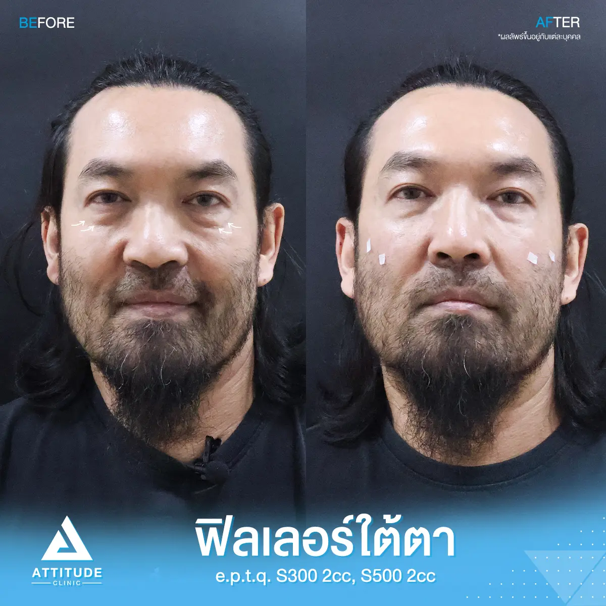 โปรโมชั่นฟิลเลอร์ e.p.t.q. ราคาพิเศษ! สวยปังในครั้งเดียว ปรับรูปหน้า เติมเต็มร่องลึก เพิ่มความมั่นใจ ฟิลเลอร์เกาหลี คุณภาพพรีเมียม ได้รับความนิยมมากที่สุด