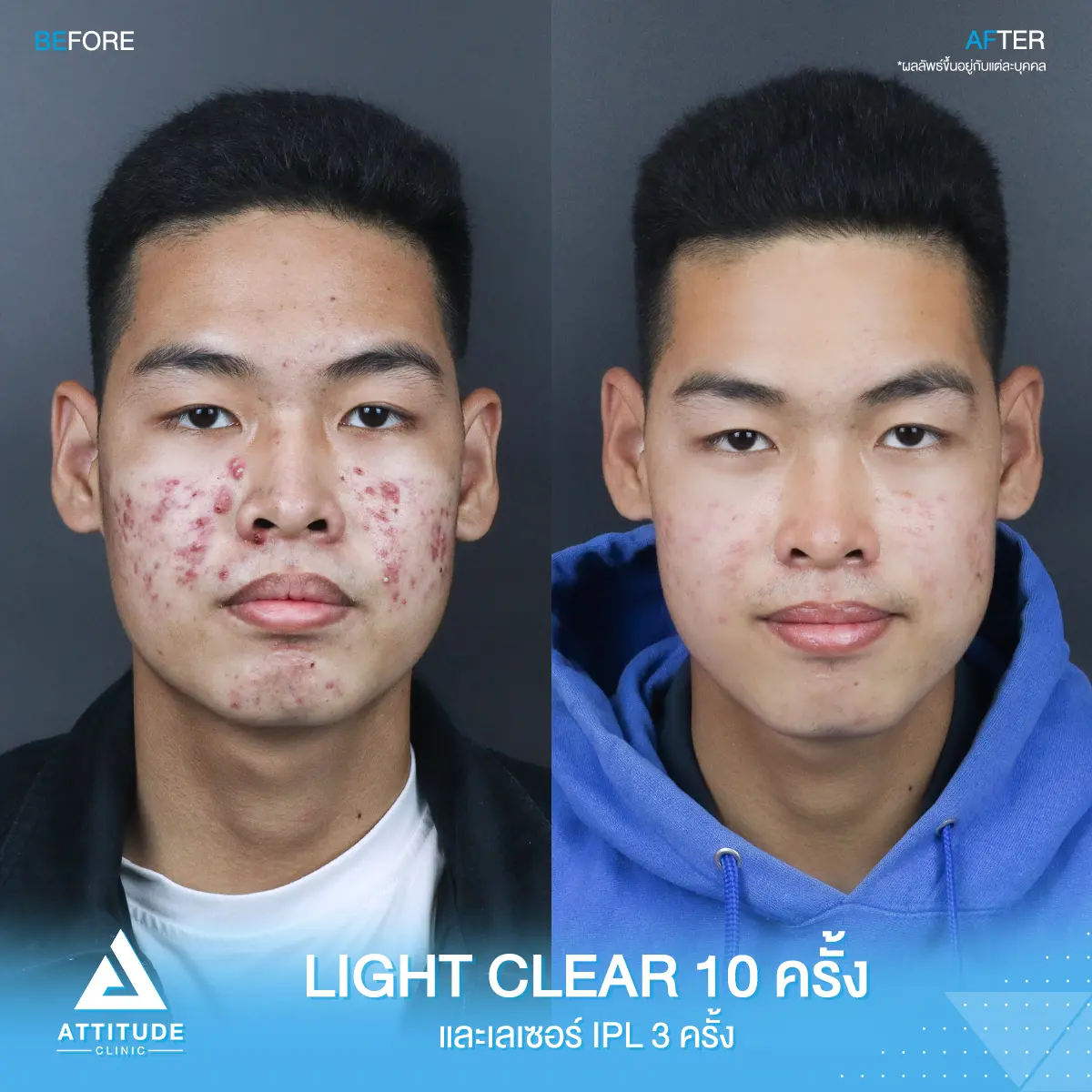 รีวิวรักษาสิว ด้วยการฉายแสง Light Clear 7 ขั้นตอน จำนวน 10 ครั้ง และเลเซอร์หน้าใส Cellec V IPL จำนวน 3 ครั้ง ของคุณอาร์ท ที่มีปัญหาสิว หลังรักษาครบคอร์สผิวหน้าดีขึ้นมากๆ สิวหาย หน้าใส มั่นใจมากขึ้น