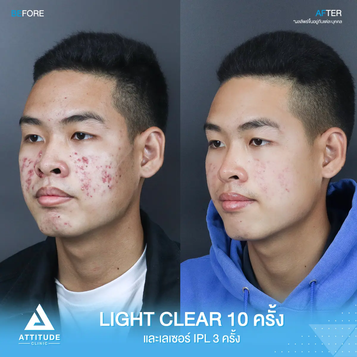 รีวิวรักษาสิว ด้วยการฉายแสง Light Clear 7 ขั้นตอน จำนวน 10 ครั้ง และเลเซอร์หน้าใส Cellec V IPL จำนวน 3 ครั้ง ของคุณอาร์ท ที่มีปัญหาสิว หลังรักษาครบคอร์สผิวหน้าดีขึ้นมากๆ สิวหาย หน้าใส มั่นใจมากขึ้น