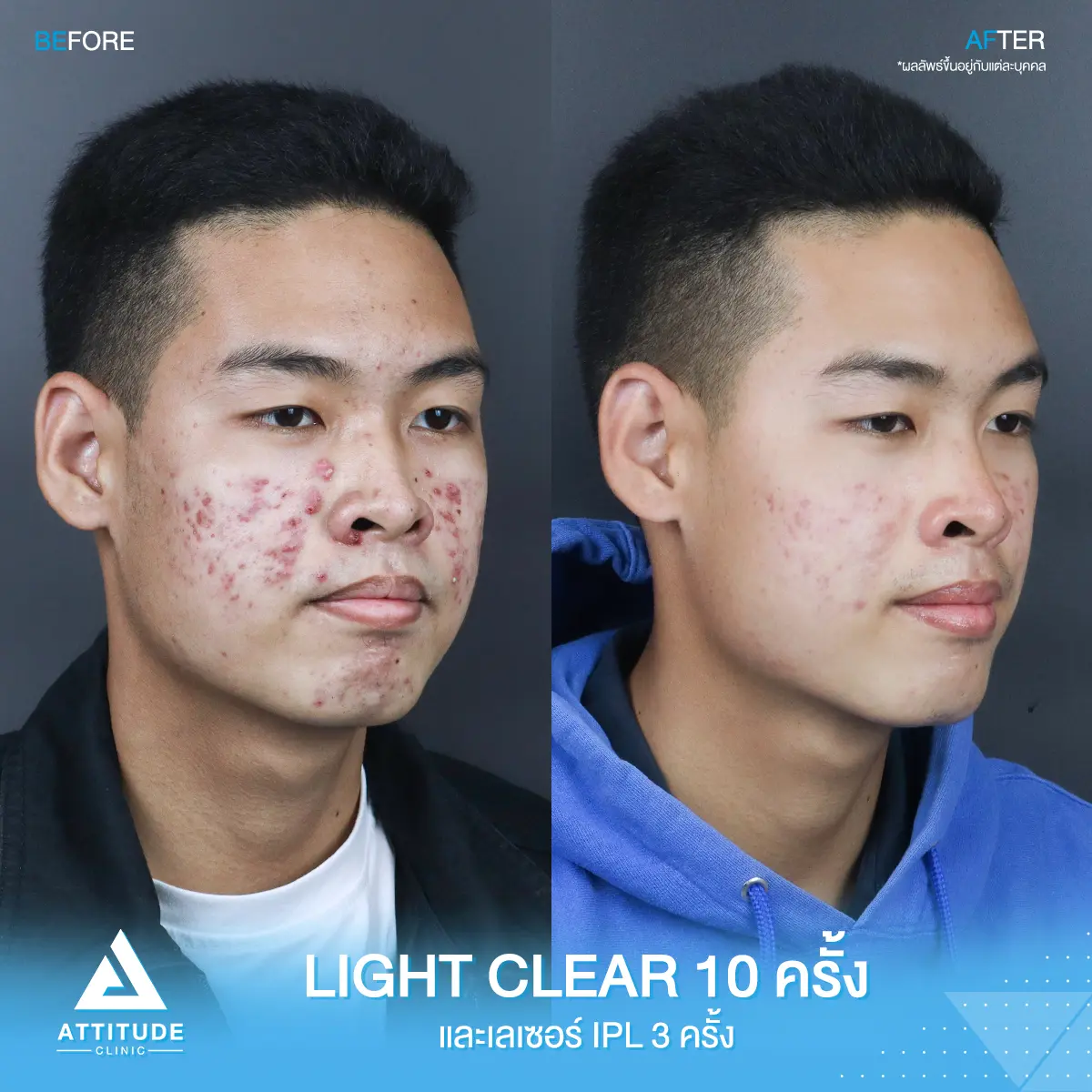 รีวิวรักษาสิว ด้วยการฉายแสง Light Clear 7 ขั้นตอน จำนวน 10 ครั้ง และเลเซอร์หน้าใส Cellec V IPL จำนวน 3 ครั้ง ของคุณอาร์ท ที่มีปัญหาสิว หลังรักษาครบคอร์สผิวหน้าดีขึ้นมากๆ สิวหาย หน้าใส มั่นใจมากขึ้น