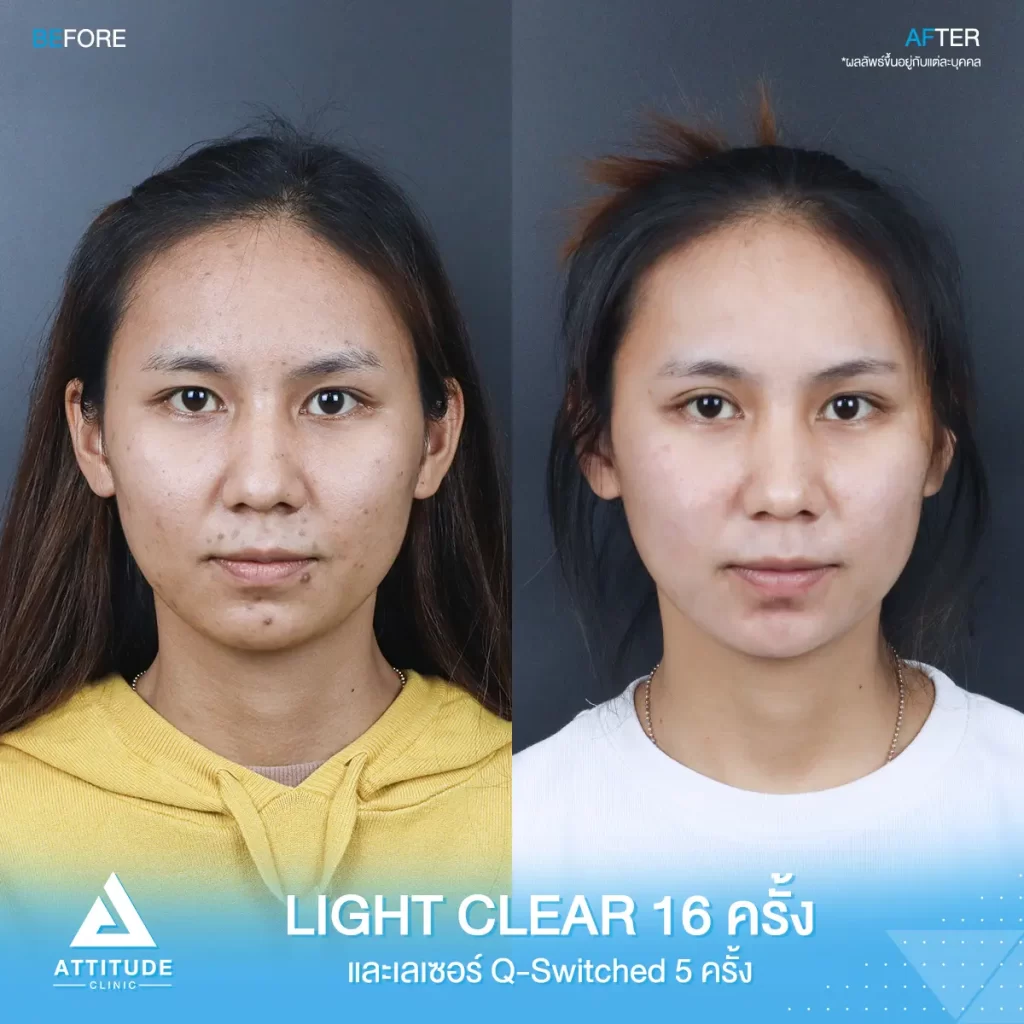 รีวิวรักษาสิว ด้วยการฉายแสง Light Clear 7 ขั้นตอน จำนวน 16 ครั้ง และเซอร์เม็ดสี ลดรอยสิว Q-switched 5 ครั้ง ของคุณอรปรียา ที่มีปัญหาสิว และรอยสิว หลังรักษาครบคอร์สตอนนี้หน้าใส มั่นใจขึ้นสุดๆ