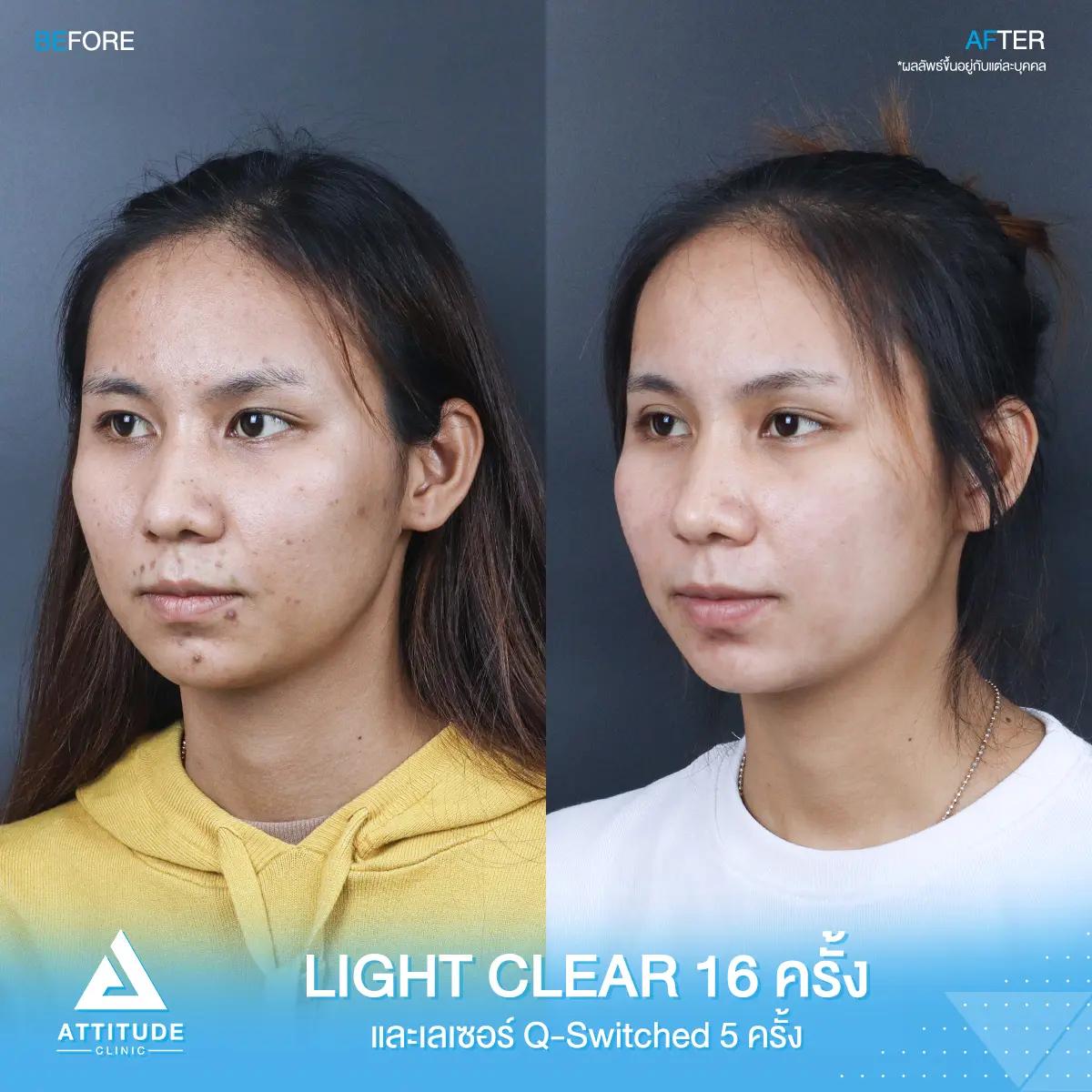 รีวิวรักษาสิว ด้วยการฉายแสง Light Clear 7 ขั้นตอน จำนวน 16 ครั้ง และเซอร์เม็ดสี ลดรอยสิว Q-switched 5 ครั้ง ของคุณอรปรียา ที่มีปัญหาสิว และรอยสิว หลังรักษาครบคอร์สตอนนี้หน้าใส มั่นใจขึ้นสุดๆ