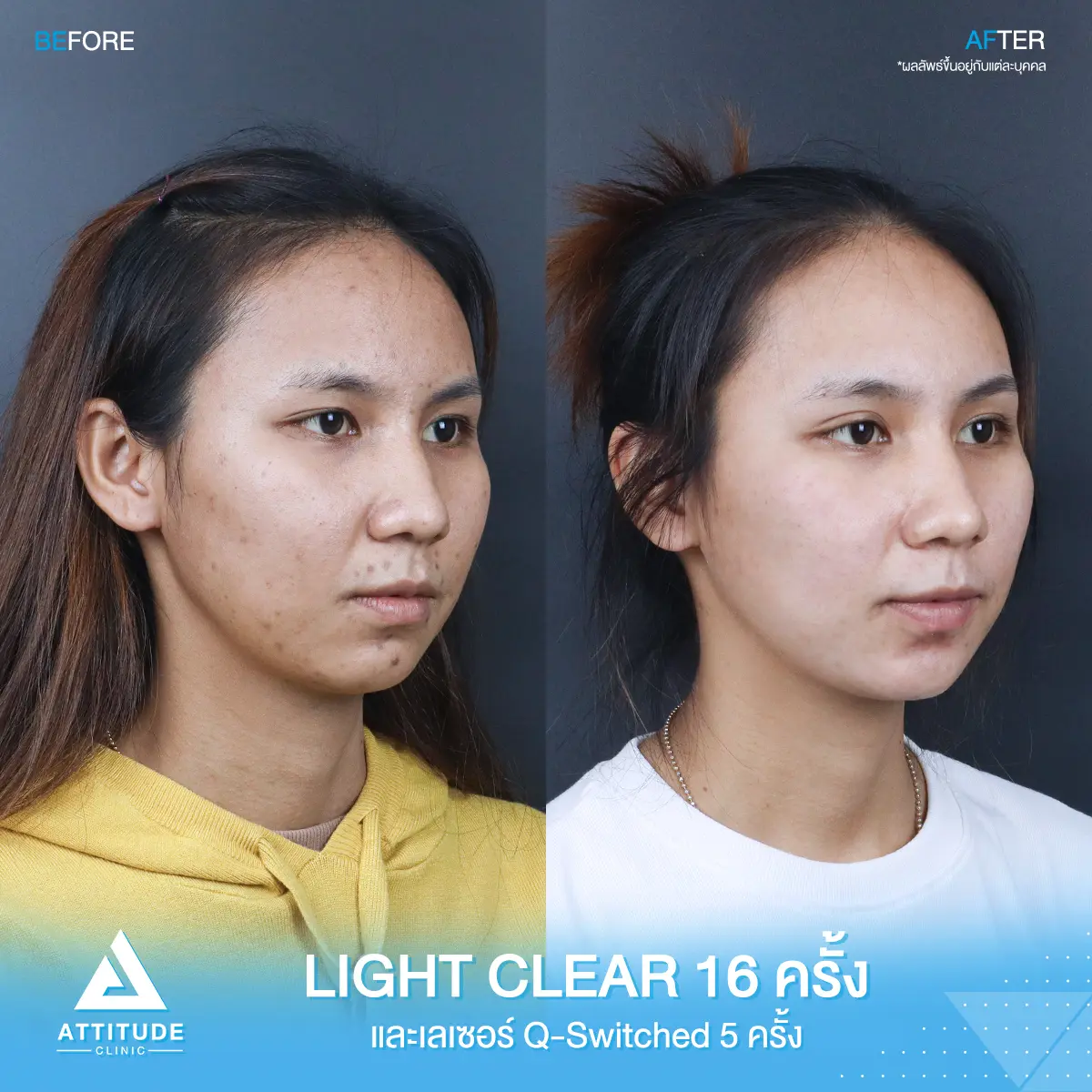 รีวิวรักษาสิว ด้วยการฉายแสง Light Clear 7 ขั้นตอน จำนวน 16 ครั้ง และเซอร์เม็ดสี ลดรอยสิว Q-switched 5 ครั้ง ของคุณอรปรียา ที่มีปัญหาสิว และรอยสิว หลังรักษาครบคอร์สตอนนี้หน้าใส มั่นใจขึ้นสุดๆ