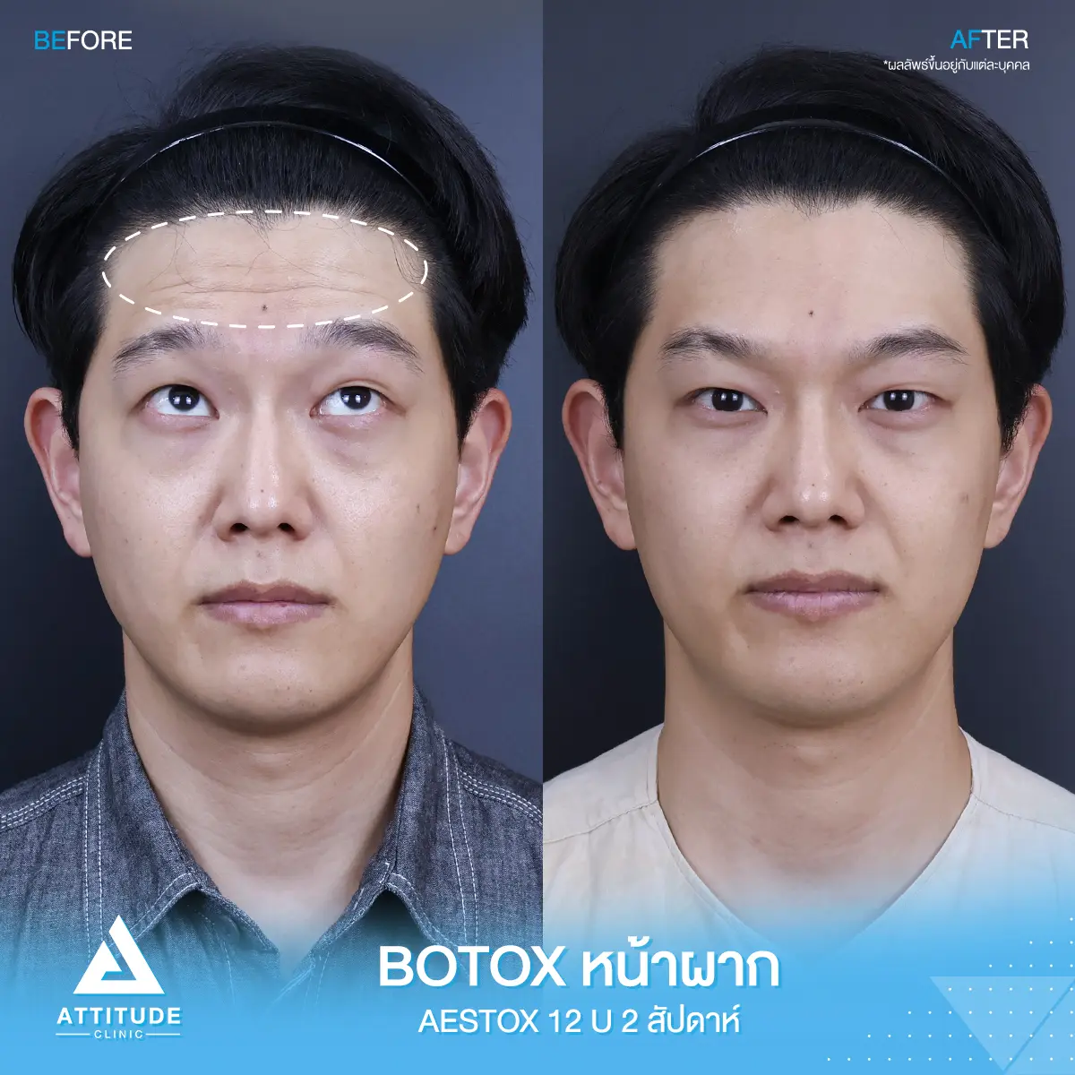 โปรโมชั่นจับคู่ลดริ้วรอยใต้ตา+หน้าผาก เพียง 1,580 บาท คุ้มเกินต้าน! ด้วย Aestox เกาหลีพรีเมียม สูตรลับหน้าเด็กลงใครก็ทักที่ Attitude Clinic