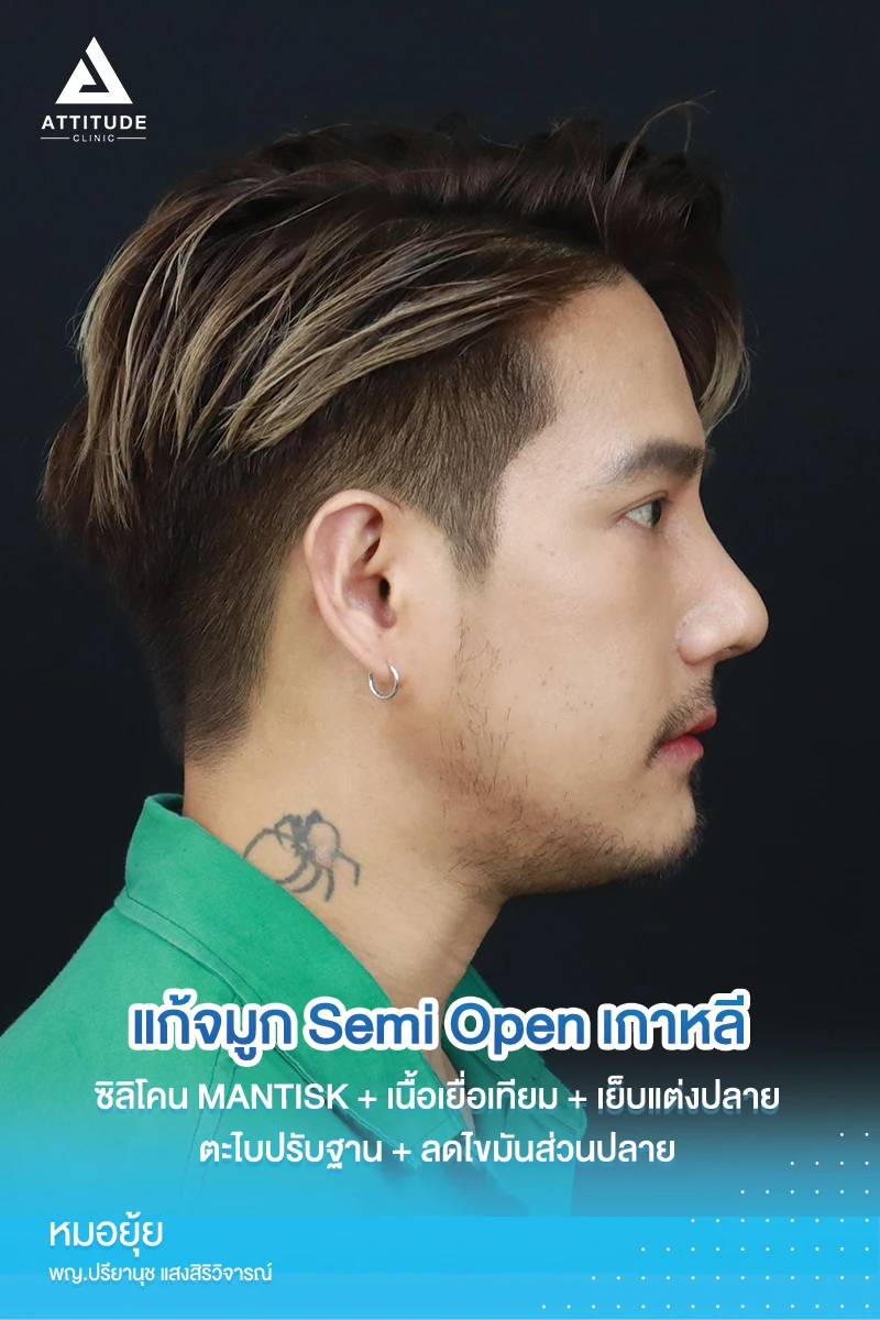 แก้จมูก