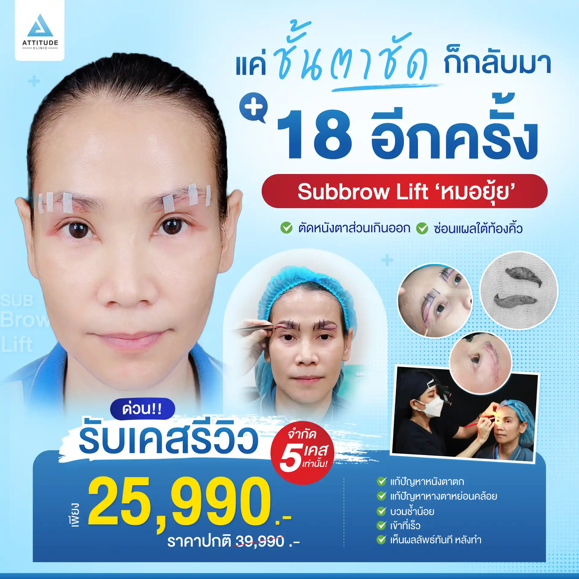 Sub Brow Lift
