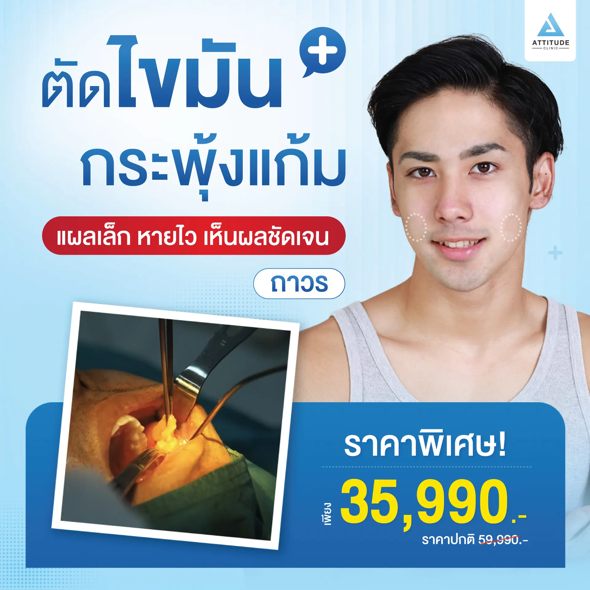 ตัดไขมันกระพุ้งแก้ม