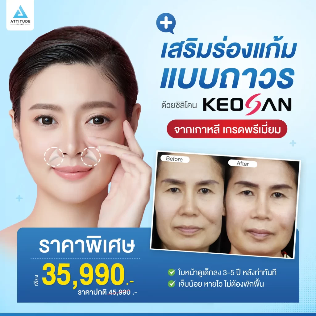 เสริมร่องแก้ม