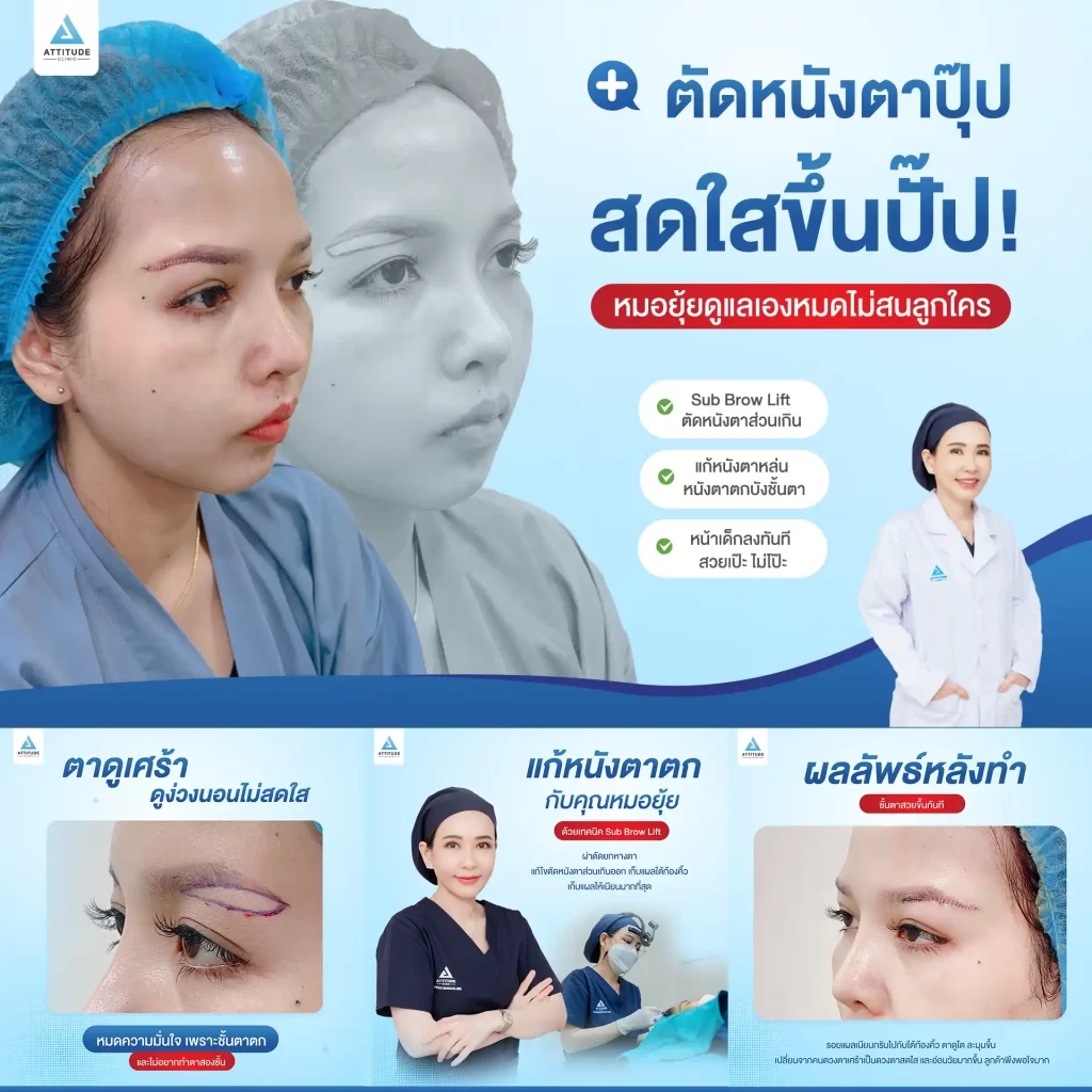 Sub Brow Lift