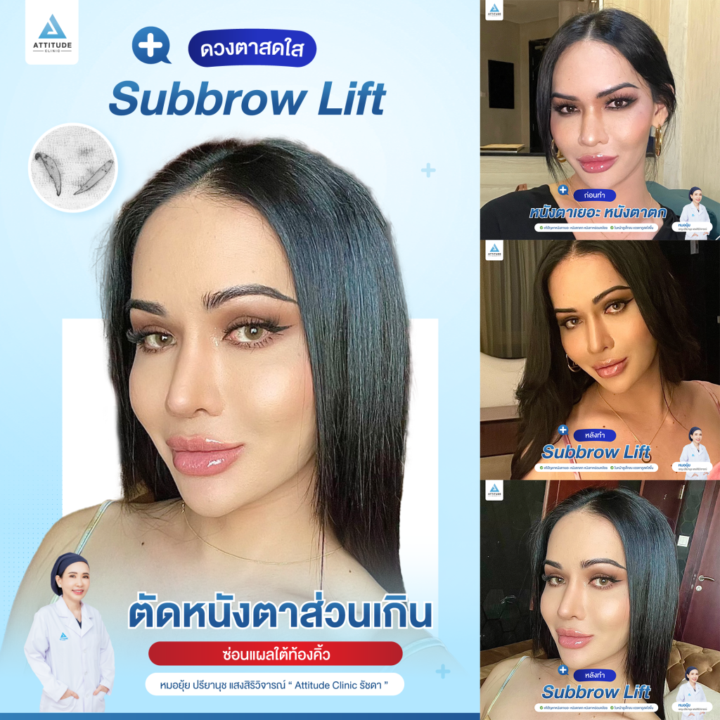 รีวิว Sub Brow Lift ผ่าตัดยกหนังตา เคสคุณเปา คืนความสดใสให้ดวงตา เก็บแผลใต้ทิ้งคิ้ว เนียนกริบ สวยเป๊ะ โดยหมอยุ้ย Attitude Clinic รัชดา