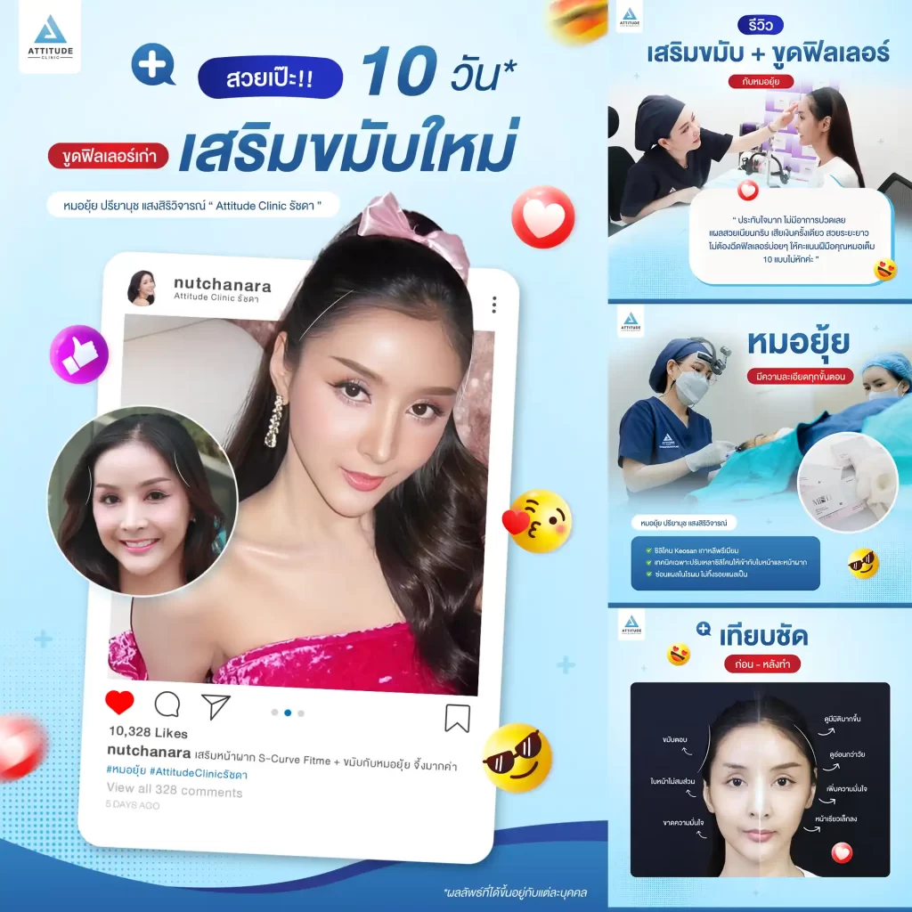 เสริมขมับ