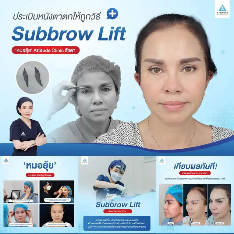 Sub Brow Lift