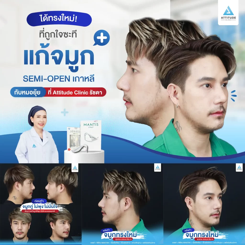เสริมจมูก