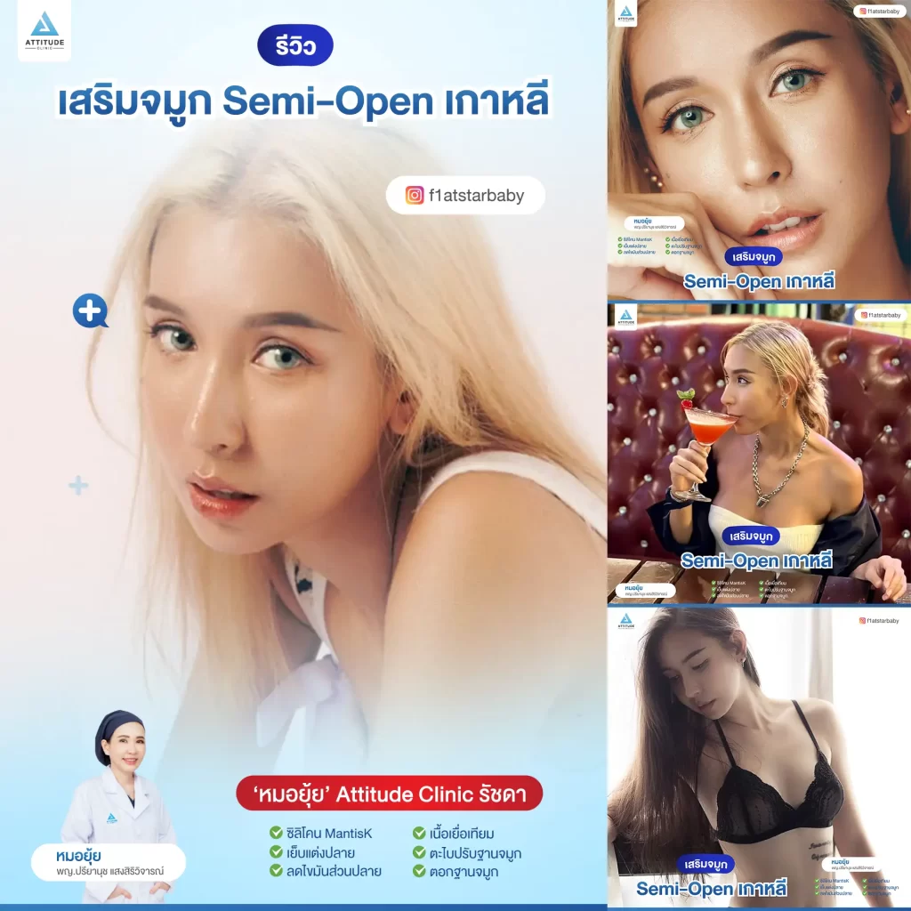 เสริมจมูก